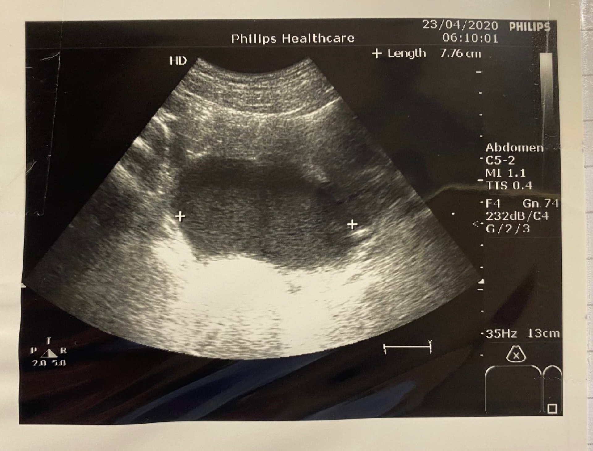 超聲波圖片顯示病人卵巢內有7厘米大的朱古力瘤腫囊。（圖片：梁巧儀醫生）