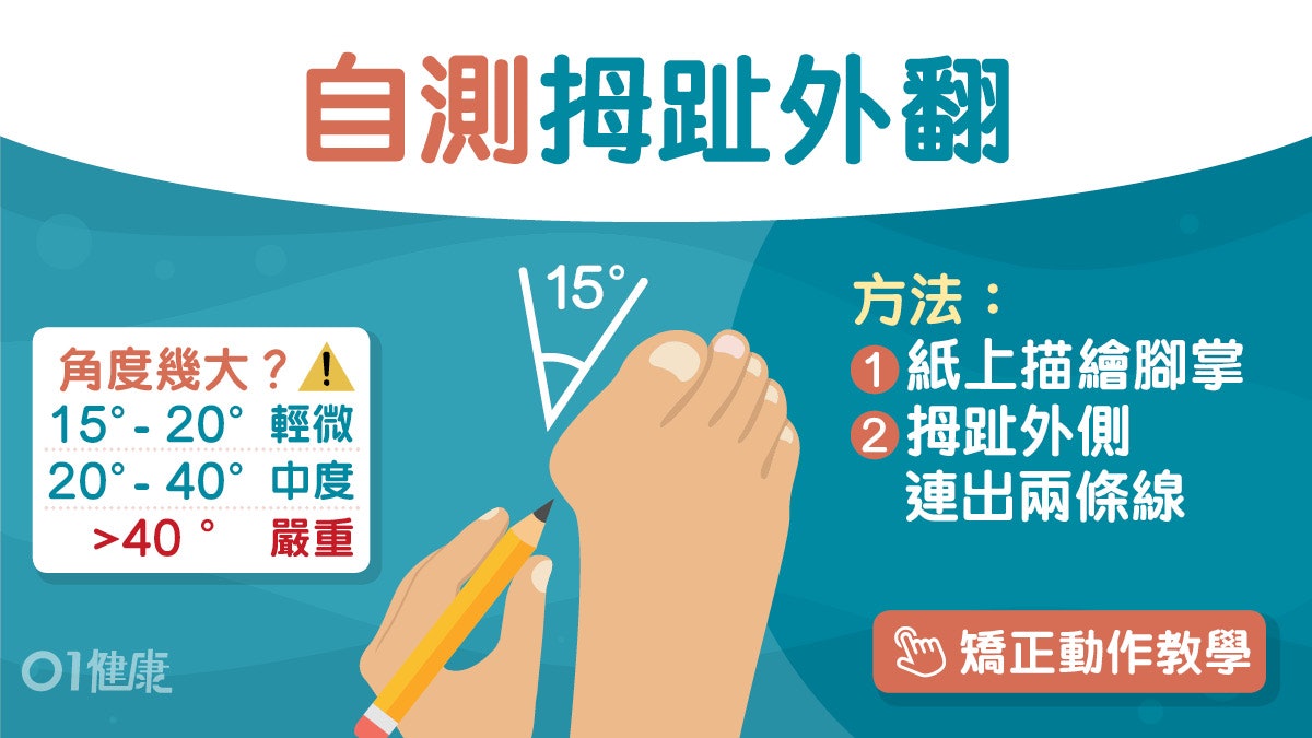 拇趾外翻|膝頭盆骨拇趾關節痛6大影響 痛到失眠必學1招踩牆! 拇趾外翻|膝頭盆骨拇趾關節痛6大影響 痛到失眠必學1招踩牆!