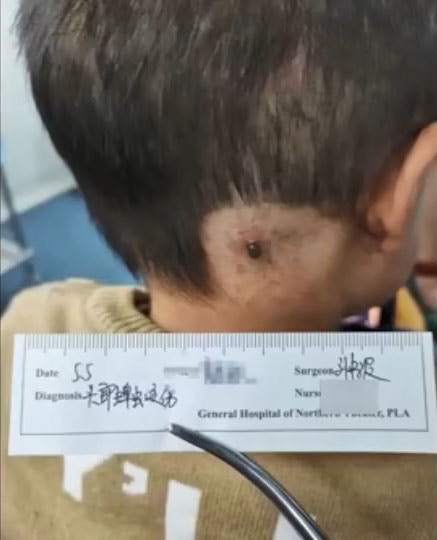 辽宁2岁男童行山时被蜱虫叮咬，5日后肿成1个肉球。（微博影片截图）