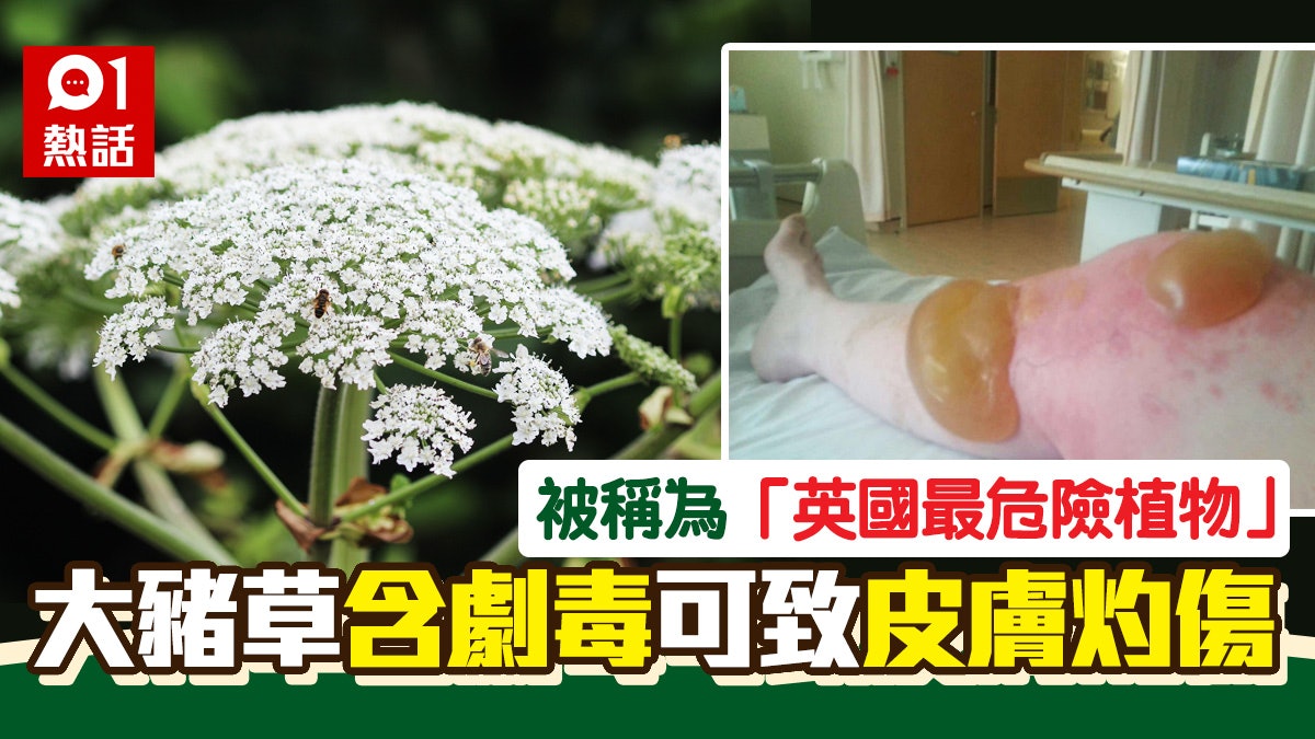 英國最危險植物 大豬草含劇毒咪亂掂觸碰汁液皮膚即生大水泡 英國最危險植物 大豬草含劇毒咪亂掂觸碰汁液皮膚即生大水泡