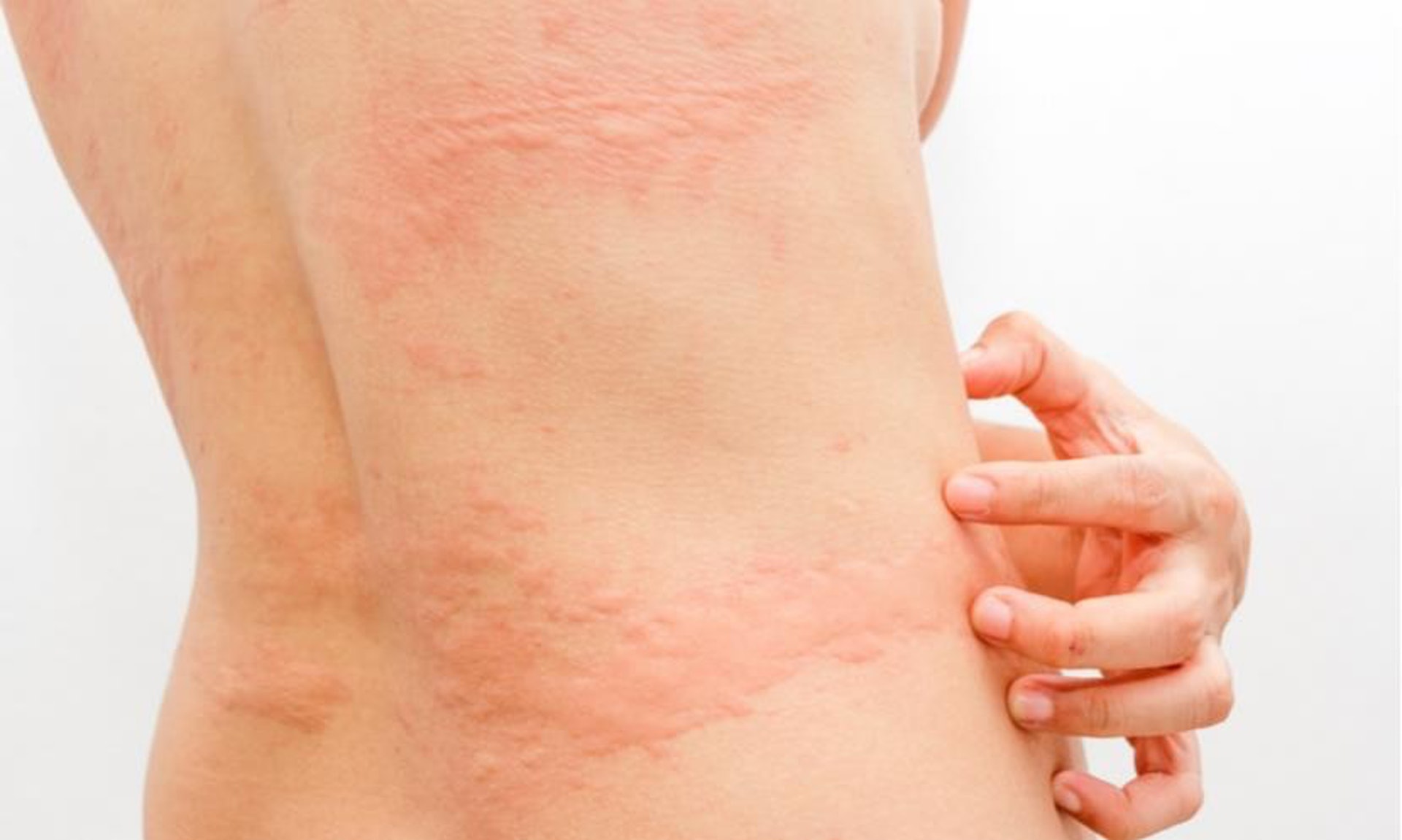 身體表面的保護屏障失衡，令濕疹問題出現。（圖片：Shutterstock）