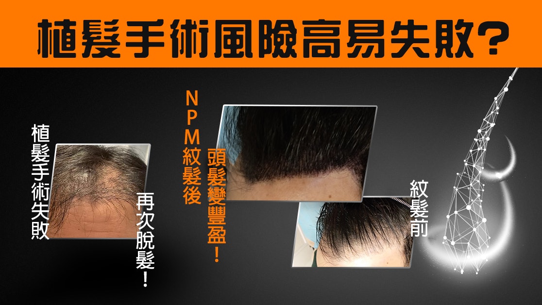 脫髮治療 想增加髮量要點揀?植髮手術 VS 專利NPM紋髮 脫髮治療 想增加髮量要點揀?植髮手術 VS 專利NPM紋髮