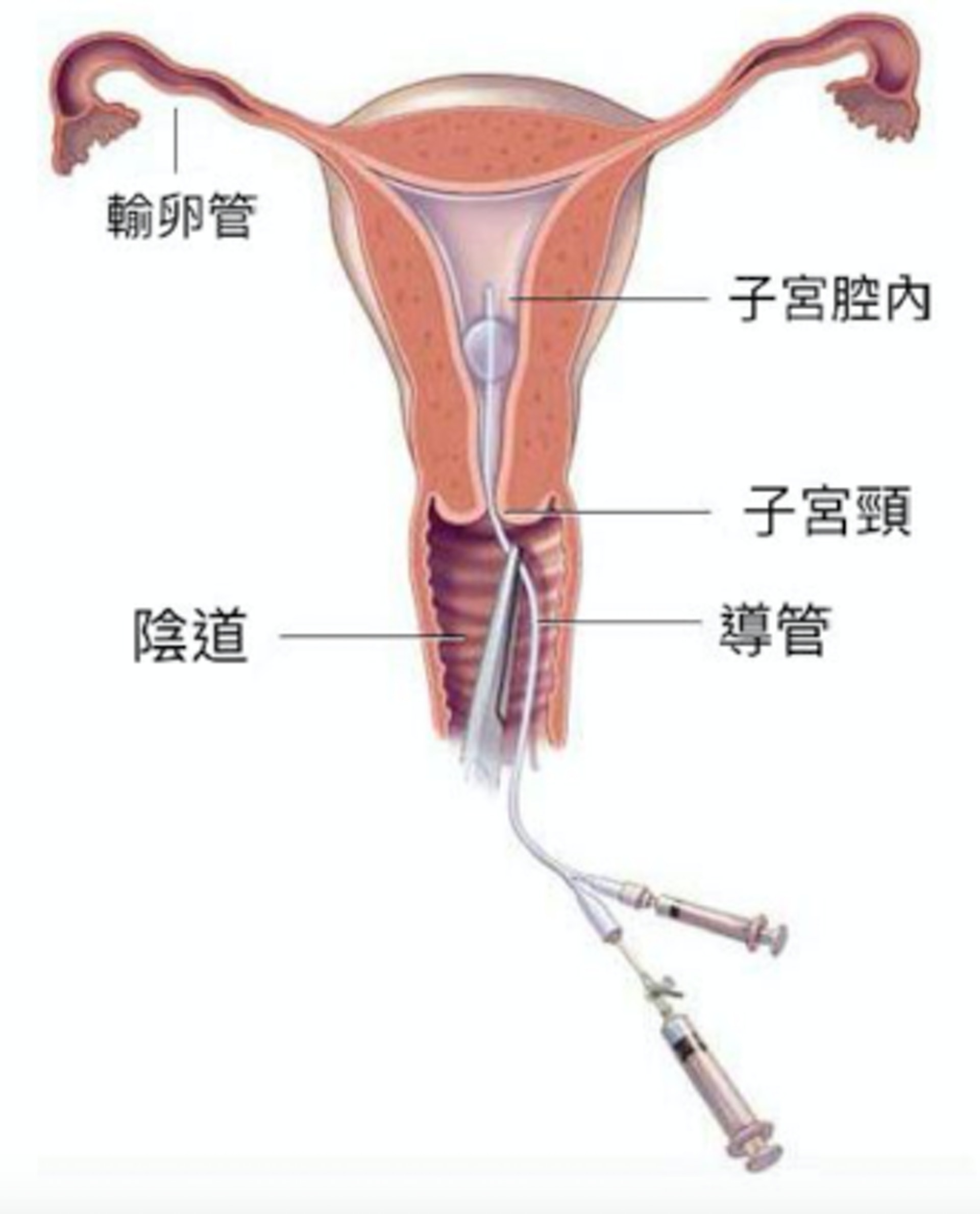 婦科醫生以導管將顯影劑注射入子宮，然後拍攝X光片，有助檢視子宮腔和輸卵管狀況是否正常。（圖片：drhannahchang）
