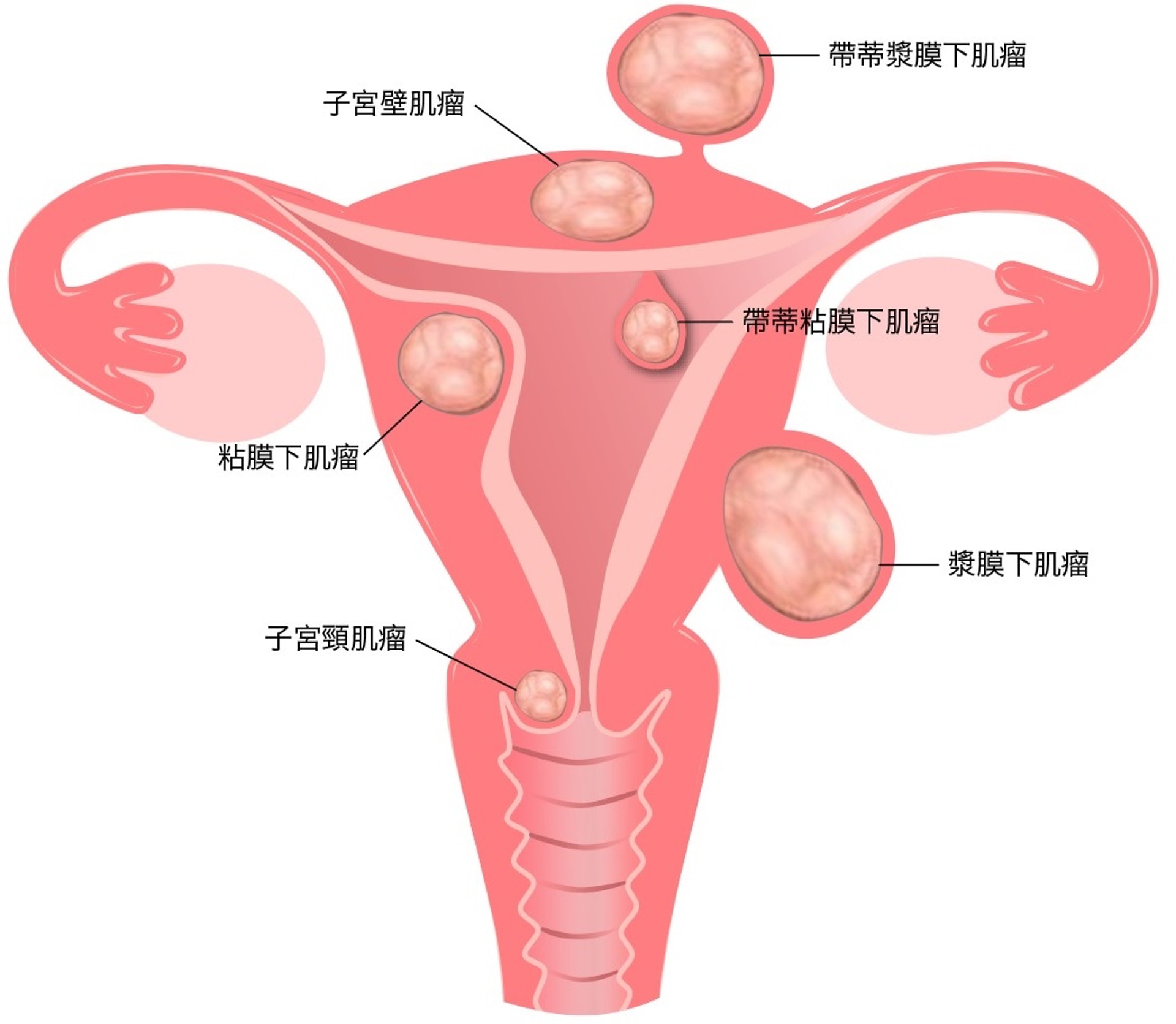 子宮肌瘤或會在子宮不同位置生長。HSG能檢測出位於宮腔或較突入至宮腔的子宮肌瘤。但假如子宮肌瘤剛巧位於其他位置，則無法通過HSG偵測出來。（圖片：hkreproductivehealth）