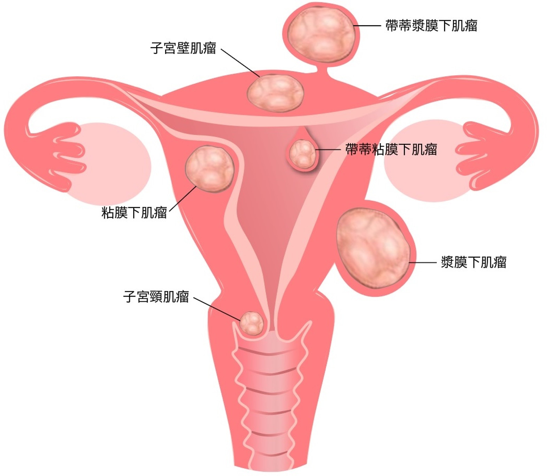 子宮肌瘤或會在子宮不同位置生長。HSG能檢測出位於宮腔或較突入至宮腔的子宮肌瘤。但假如子宮肌瘤剛巧位於其他位置,則無法通過HSG偵測出來。(圖片:hkreproductivehealth) 子宮肌瘤或會在子宮不同位置生長。HSG能檢測出位於宮腔或較突入至宮腔的子宮肌瘤。但假如子宮肌瘤剛巧位於其他位置,則無法通過HSG偵測出來。(圖片:hkreproductivehealth)