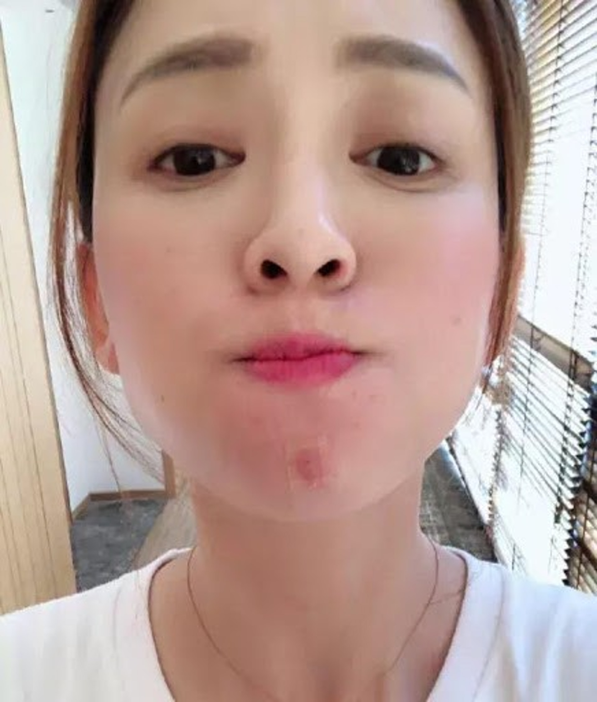 許多人一長出痘痘便立即貼上暗瘡貼,其實這是錯誤的做法。(陳喬恩微博) 許多人一長出痘痘便立即貼上暗瘡貼,其實這是錯誤的做法。(陳喬恩微博)