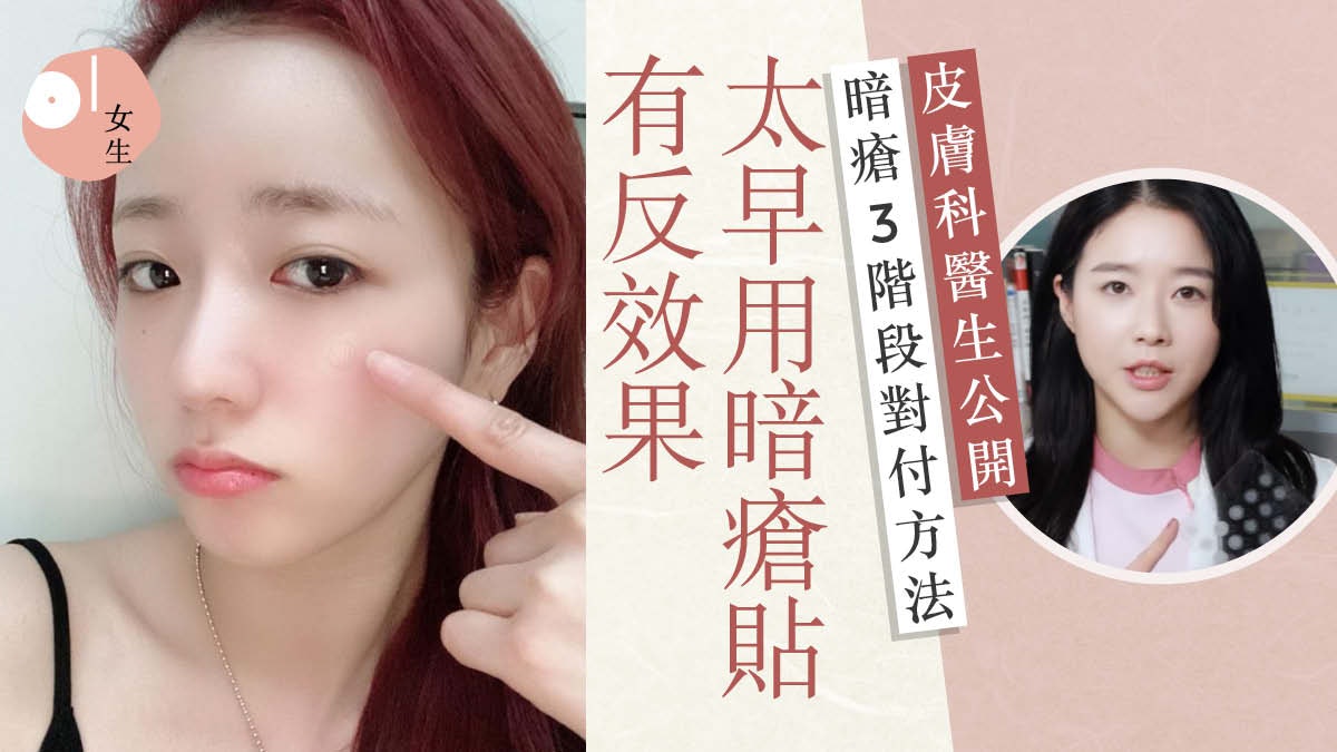 暗瘡|皮膚科醫生教3階段對付暗瘡 根據痘印顏色推薦去印好物 暗瘡|皮膚科醫生教3階段對付暗瘡 根據痘印顏色推薦去印好物