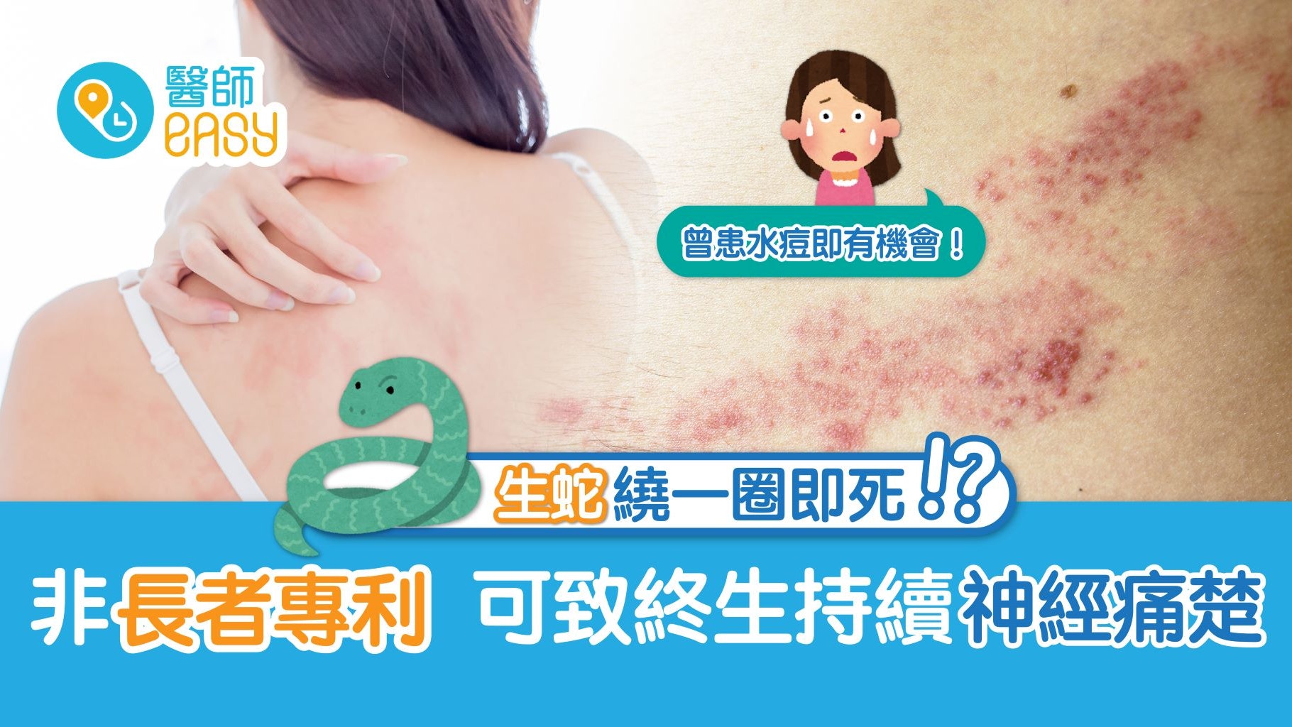 生蛇│圍繞一圈致死?病毒可潛伏一生 嚴重可變長期神經痛症 生蛇│圍繞一圈致死?病毒可潛伏一生 嚴重可變長期神經痛症