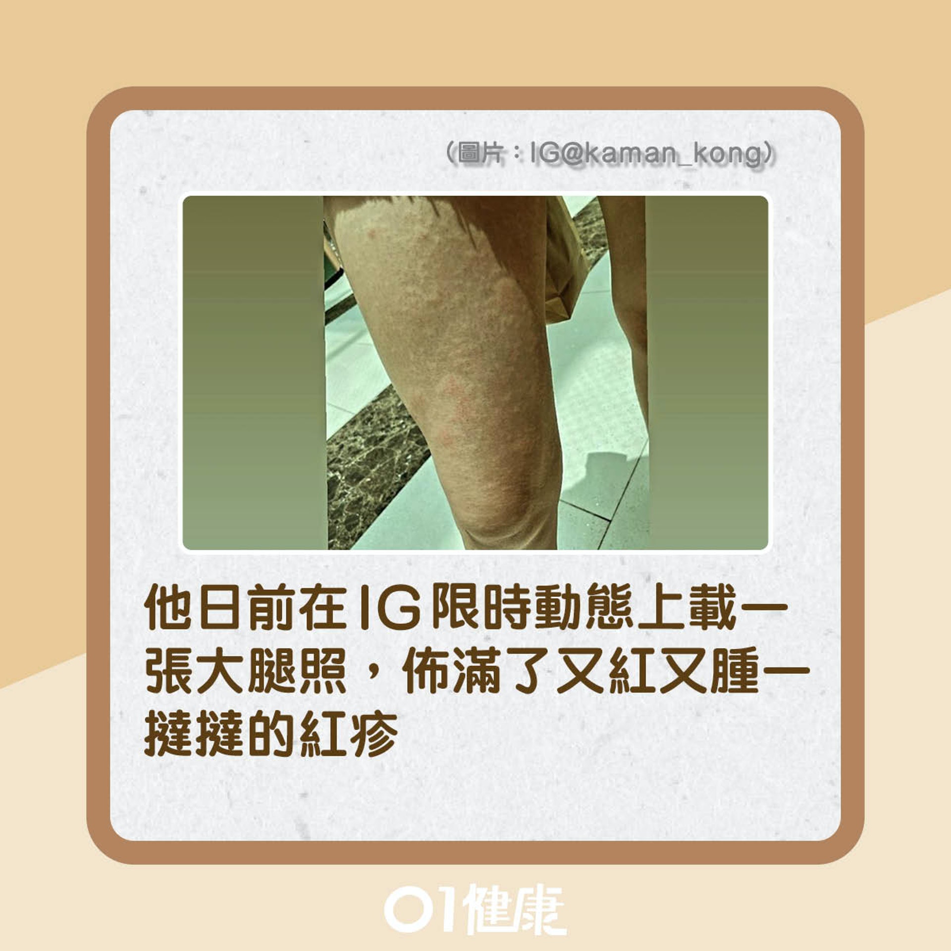 江嘉敏生風癩,大腿又紅又腫(01製圖) 江嘉敏生風癩,大腿又紅又腫(01製圖)