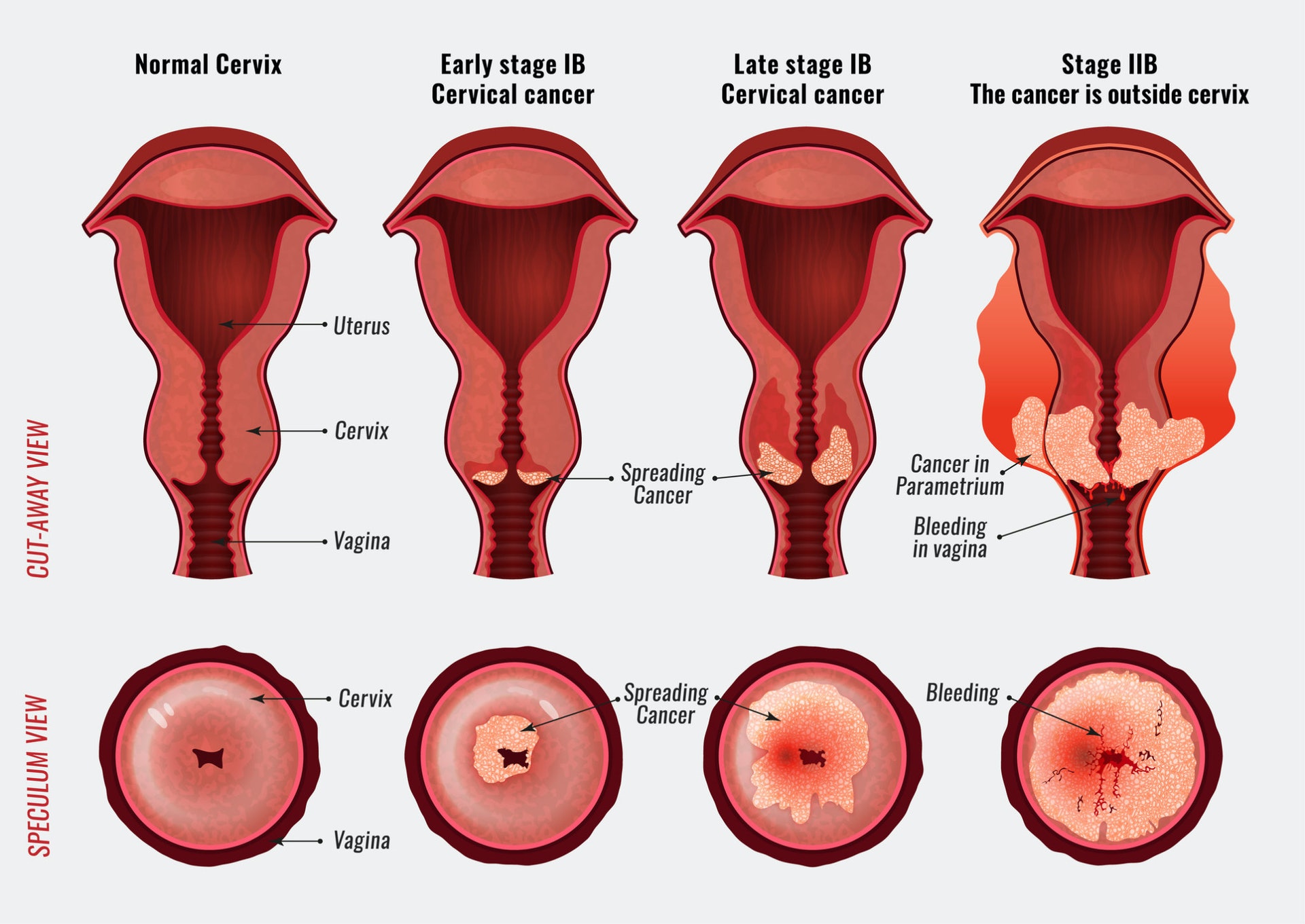 子宮頸細胞病變過程，最左為正常的子宮頸，最右為癌細胞已擴散的子宮頸。（圖片：singing river health system）