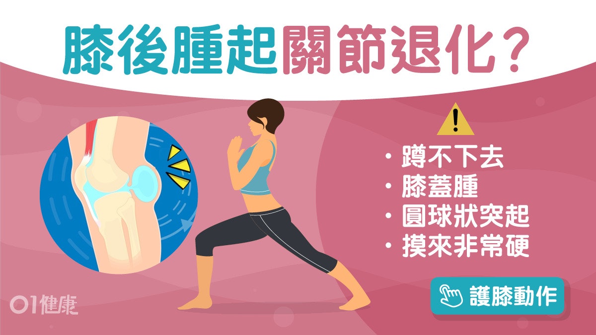 膝蓋痛|腫脹有積水或貝克氏囊腫!半月板受損4原因點知關節退化? 膝蓋痛|腫脹有積水或貝克氏囊腫!半月板受損4原因點知關節退化?