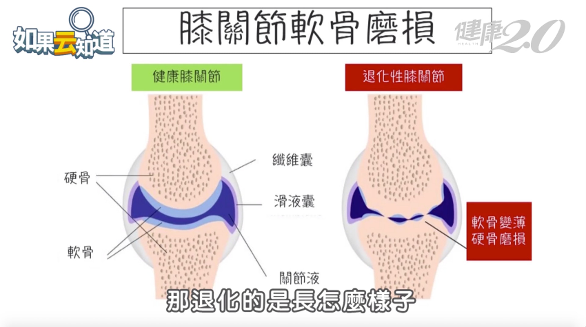 膝關節軟骨磨損(健康2.0授權使用) 膝關節軟骨磨損(健康2.0授權使用)