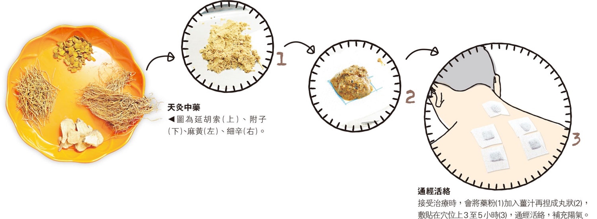 藥貼會採用辛溫透散的材料如白芥子、細辛、延胡索、附子、麻黃及薑汁等。(圖片:gloryin) 藥貼會採用辛溫透散的材料如白芥子、細辛、延胡索、附子、麻黃及薑汁等。(圖片:gloryin)