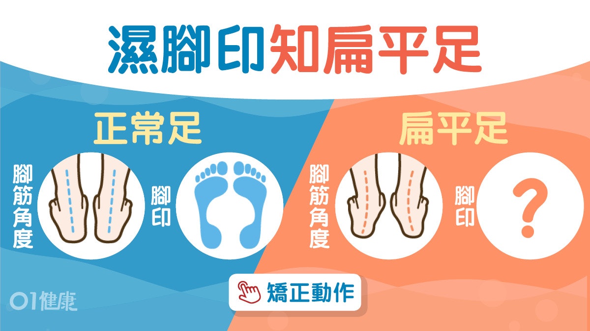 扁平足|拇趾外翻易跌易腳酸7症狀 小心損韌帶盆骨歪必學2招改善 扁平足|拇趾外翻易跌易腳酸7症狀 小心損韌帶盆骨歪必學2招改善
