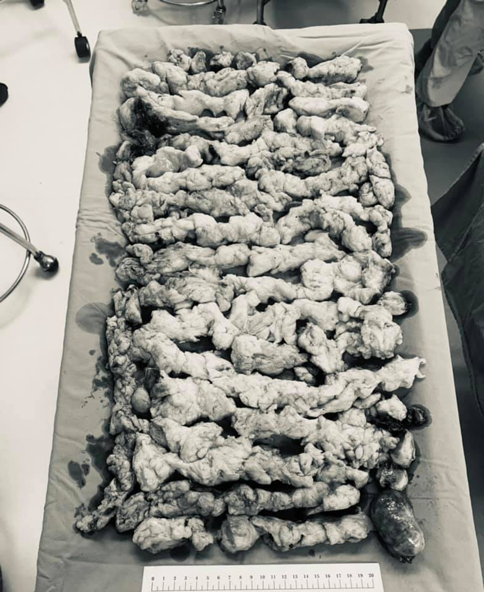 李醫生把切下來的肌瘤排在手術台上,像盛裝在碗中的肉羹。(fb專頁「Dr. 李偉浩的婦科手術室」圖片) 李醫生把切下來的肌瘤排在手術台上,像盛裝在碗中的肉羹。(fb專頁「Dr. 李偉浩的婦科手術室」圖片)