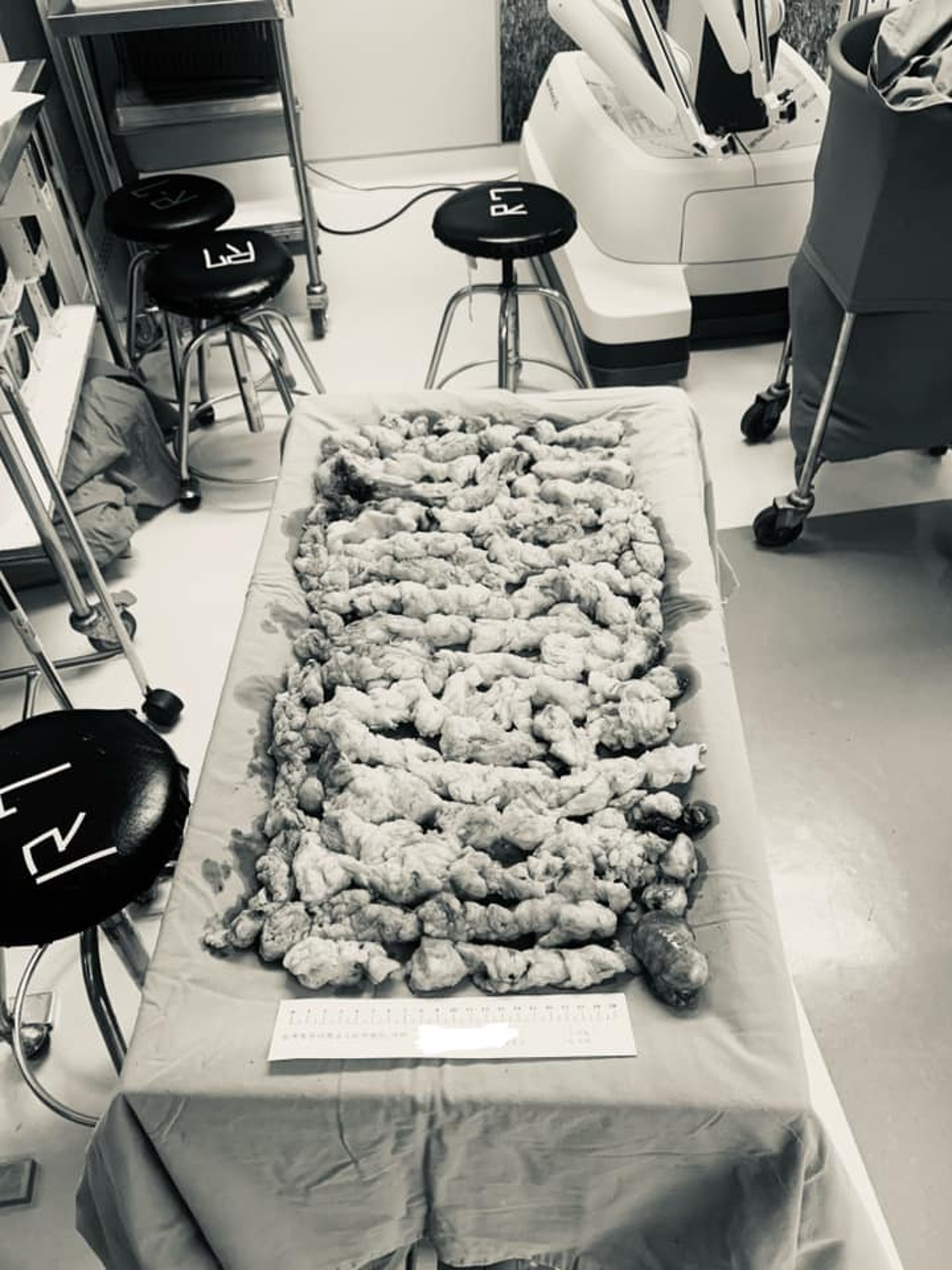 李醫生把切下來的肌瘤排在手術台上,像盛裝在碗中的肉羹。(fb專頁「Dr. 李偉浩的婦科手術室」圖片) 李醫生把切下來的肌瘤排在手術台上,像盛裝在碗中的肉羹。(fb專頁「Dr. 李偉浩的婦科手術室」圖片)