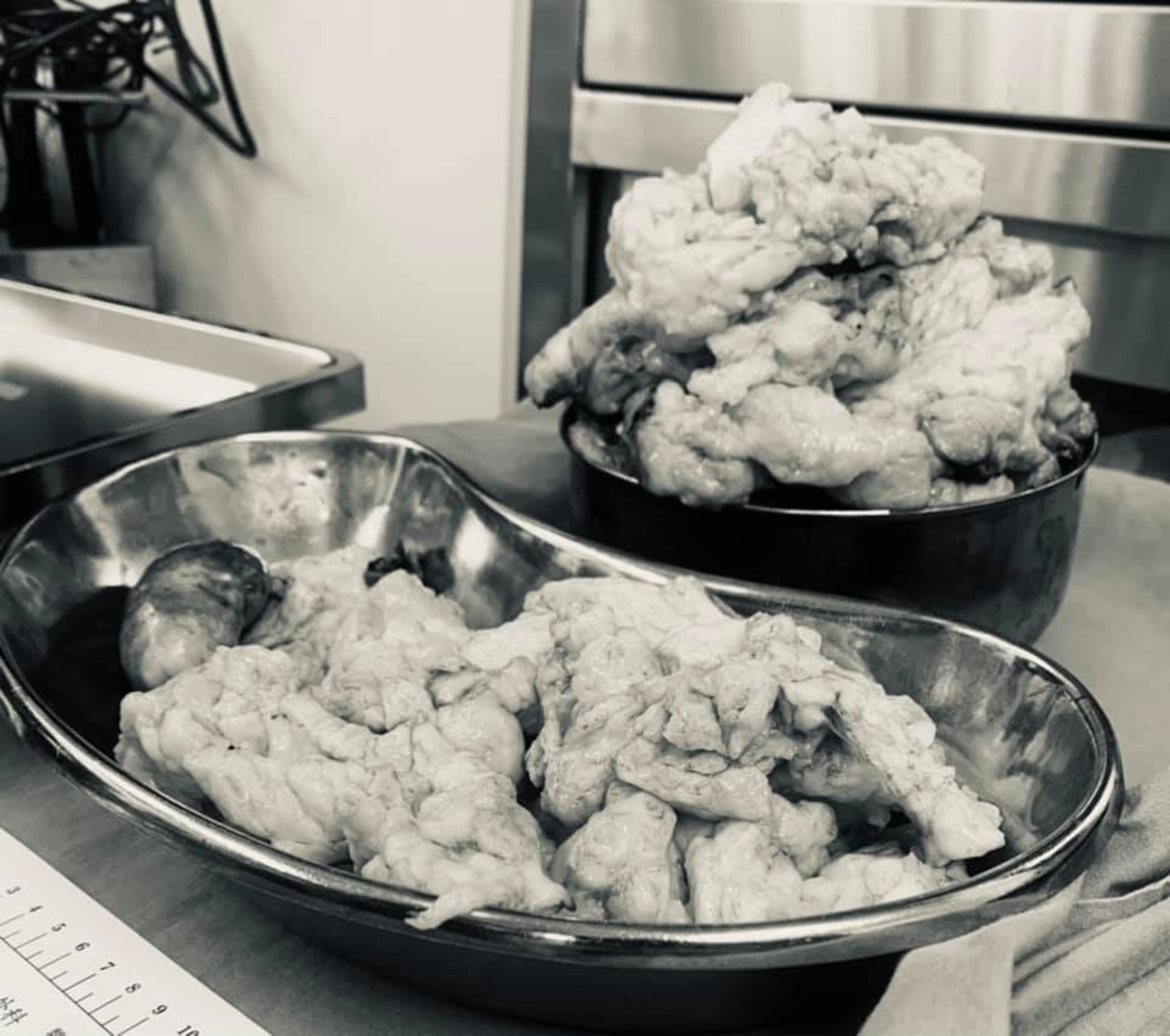 李醫生把切下來的肌瘤排在手術台上,像盛裝在碗中的肉羹。(fb專頁「Dr. 李偉浩的婦科手術室」圖片) 李醫生把切下來的肌瘤排在手術台上,像盛裝在碗中的肉羹。(fb專頁「Dr. 李偉浩的婦科手術室」圖片)