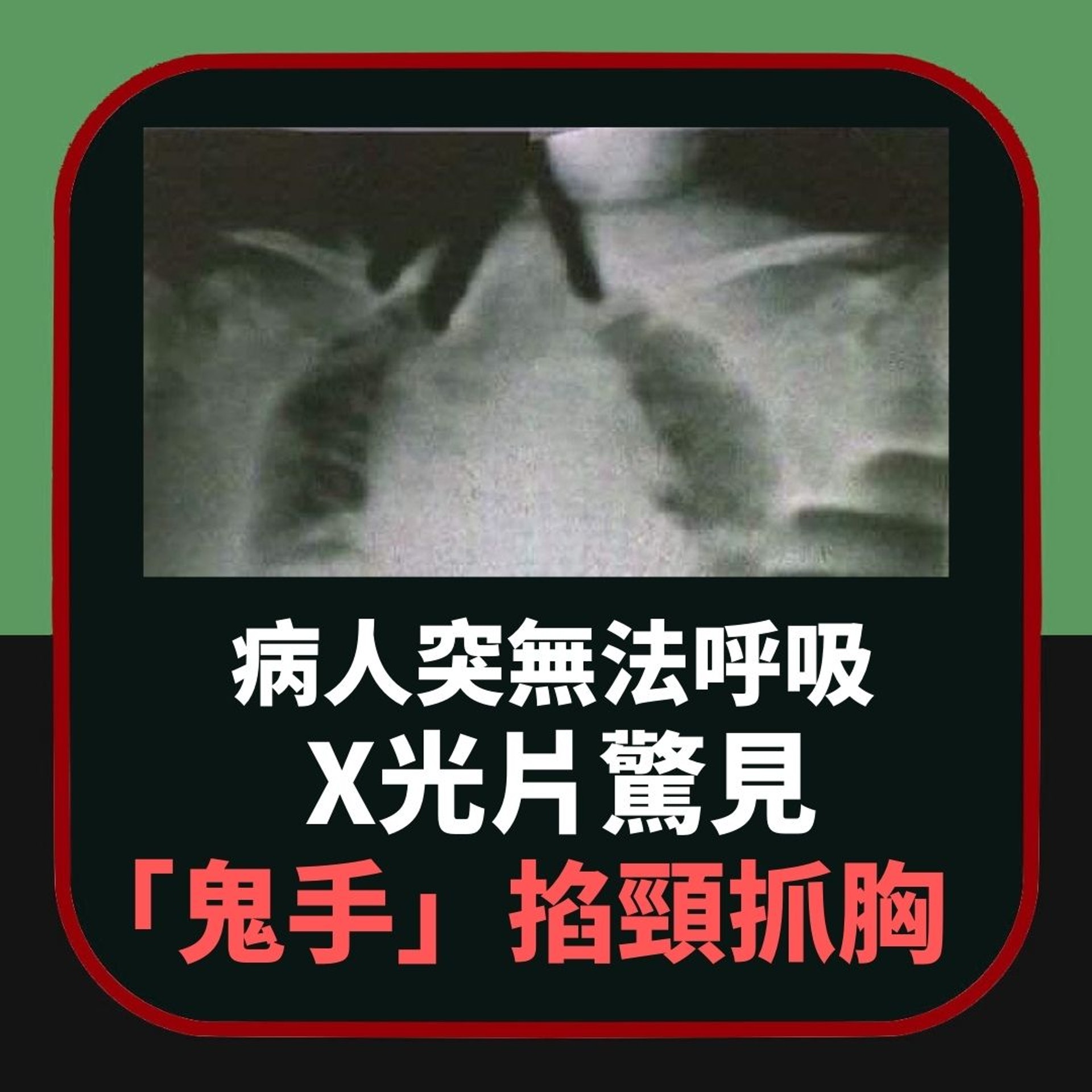 病人突無法呼吸 X光片驚見「鬼手」掐頸抓胸(01製圖) 病人突無法呼吸 X光片驚見「鬼手」掐頸抓胸(01製圖)