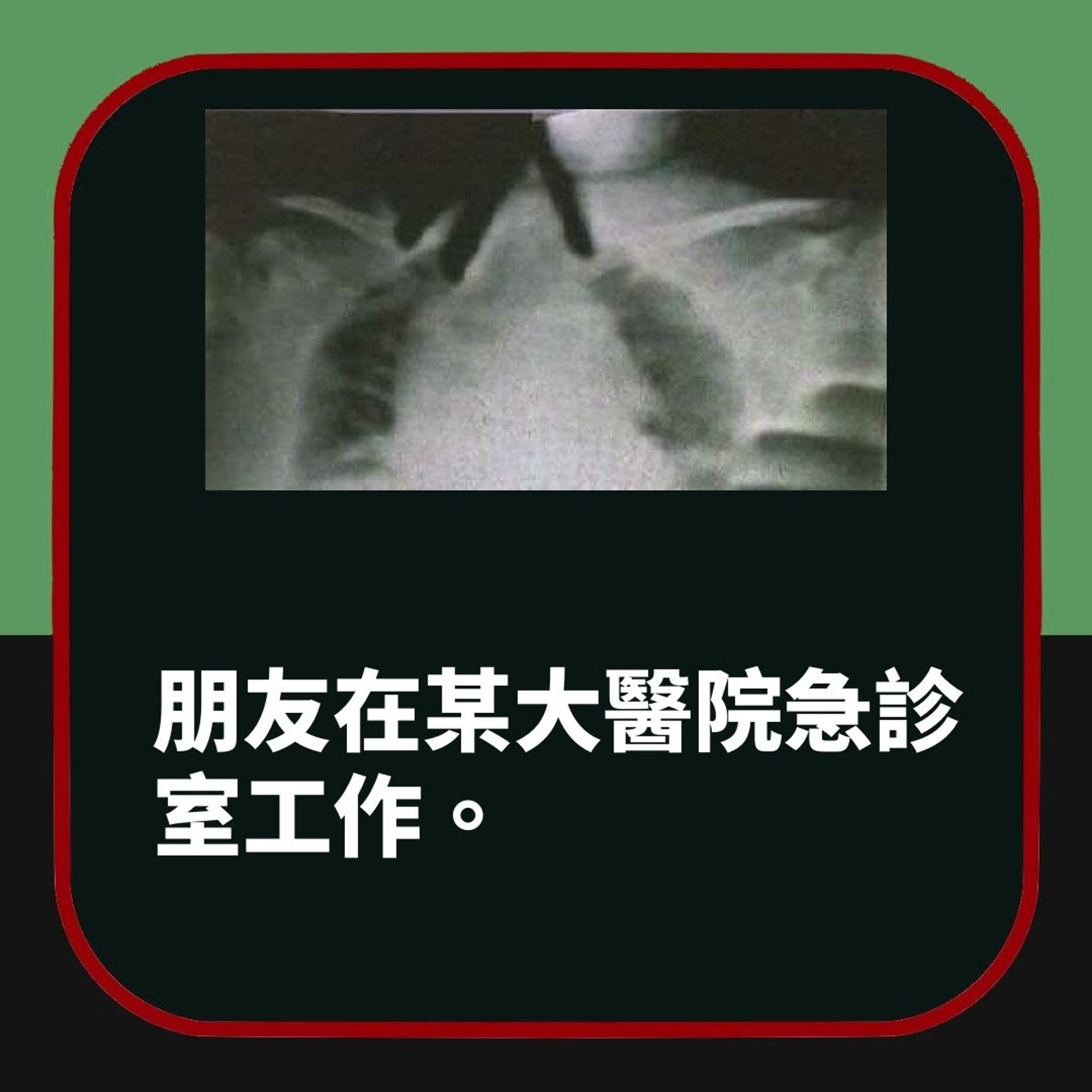 病人突無法呼吸 X光片驚見「鬼手」掐頸抓胸(01製圖) 病人突無法呼吸 X光片驚見「鬼手」掐頸抓胸(01製圖)