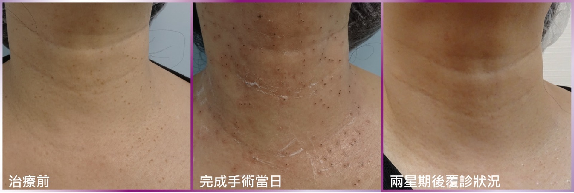 處理疣這類具傳染性的病毒,須在無菌手術室進行,將疣病毒傳染機會降到最低。(圖片:K-Centric) 處理疣這類具傳染性的病毒,須在無菌手術室進行,將疣病毒傳染機會降到最低。(圖片:K-Centric)