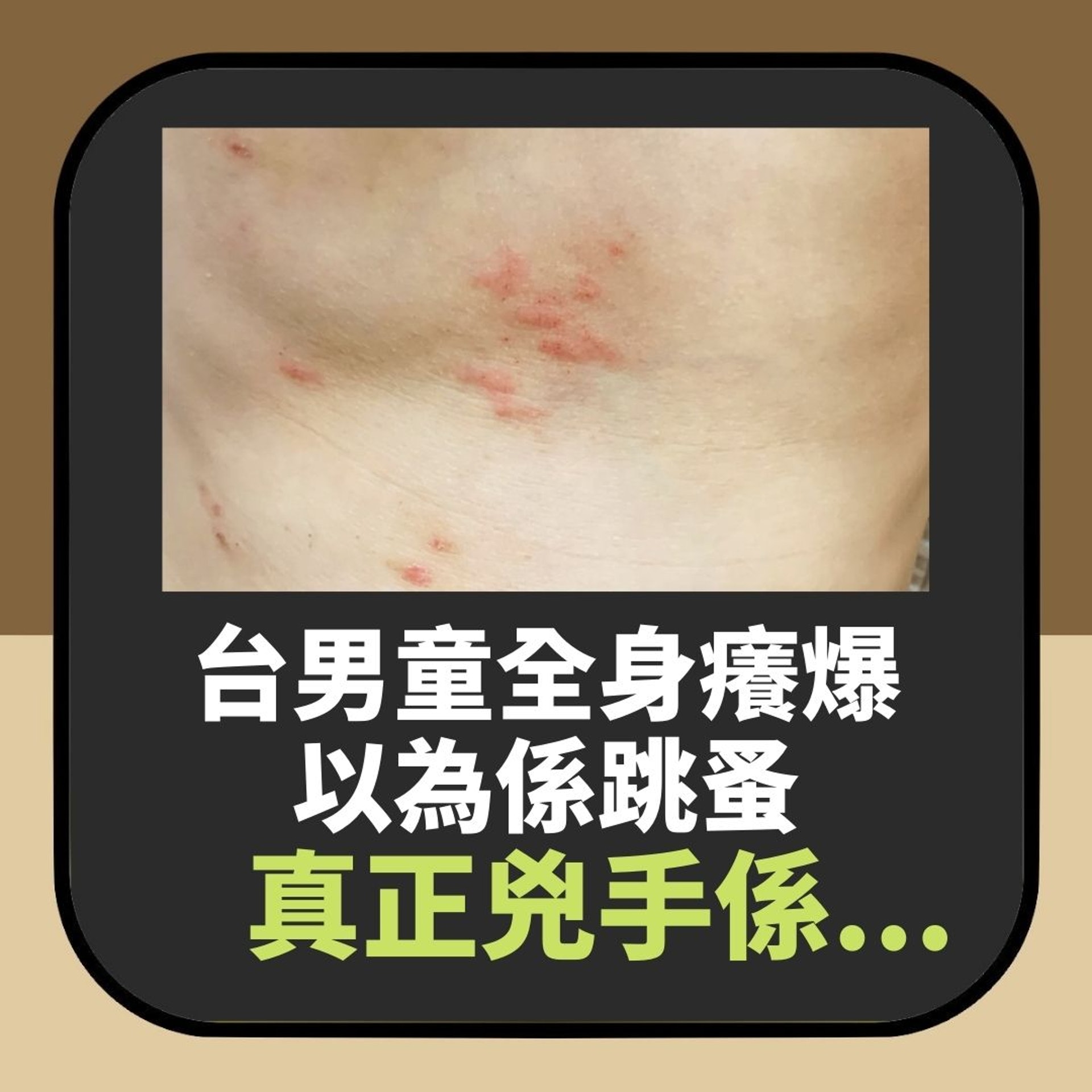 【台男童以為畀蚤咬 睇醫生先知係「佢」 會沿冷氣機入侵香港都有】(01製圖) 【台男童以為畀蚤咬 睇醫生先知係「佢」 會沿冷氣機入侵香港都有】(01製圖)