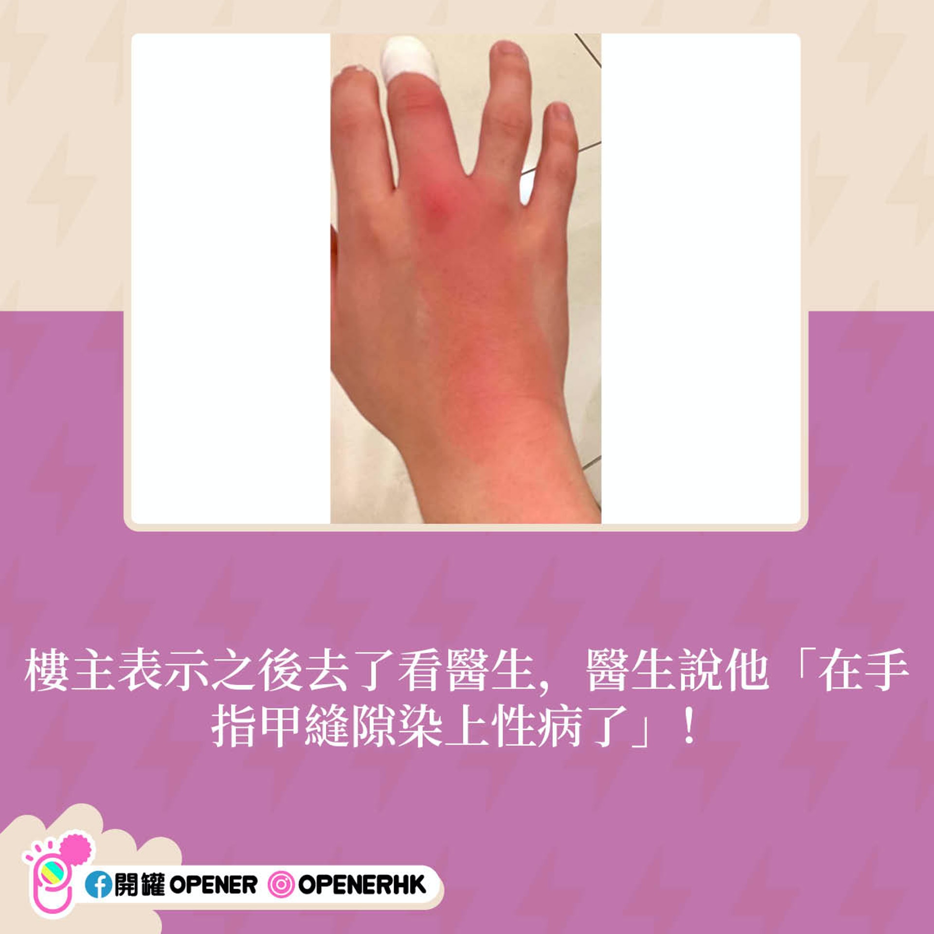 男生跟SP大戰後手指甲生性病腫到去下巴 醫生睇完相後揭另有內情 男生跟SP大戰後手指甲生性病腫到去下巴 醫生睇完相後揭另有內情