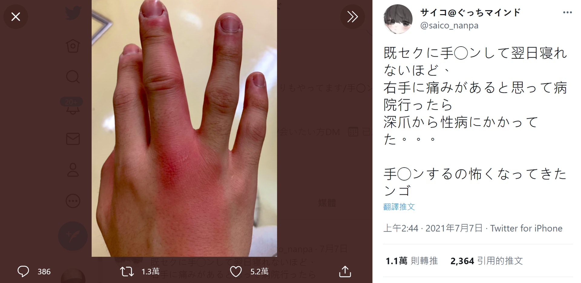 男生跟sp大戰後指甲生性病腫到去下巴 香港醫生睇相後揭另有內情 男生跟sp大戰後指甲生性病腫到去下巴 香港醫生睇相後揭另有內情