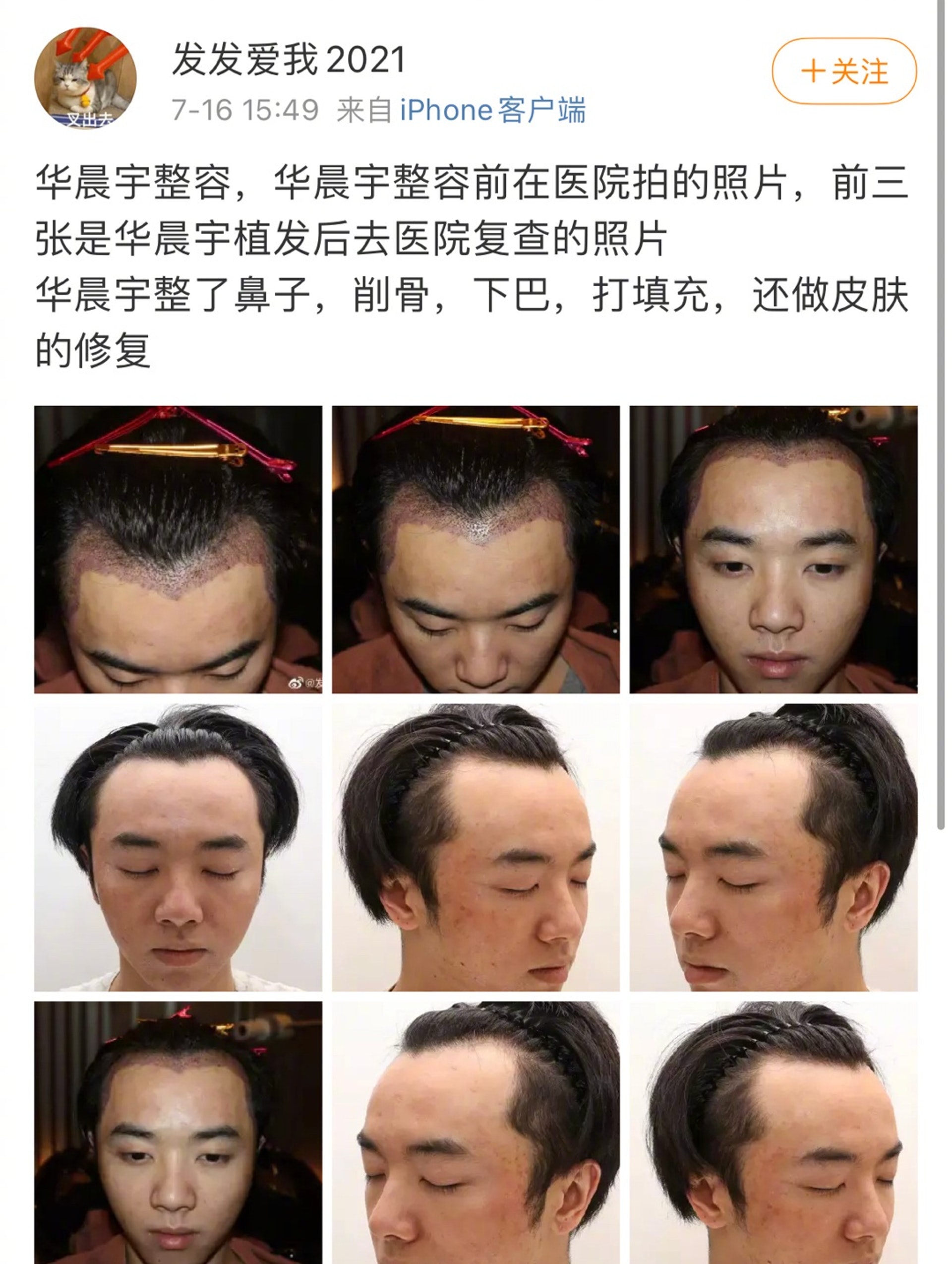 華晨宇遭網民貼圖爆整容堅持法律追究不接受道歉 香港01 即時娛樂 華晨宇遭網民貼圖爆整容堅持法律追究不接受道歉 香港01 即時娛樂
