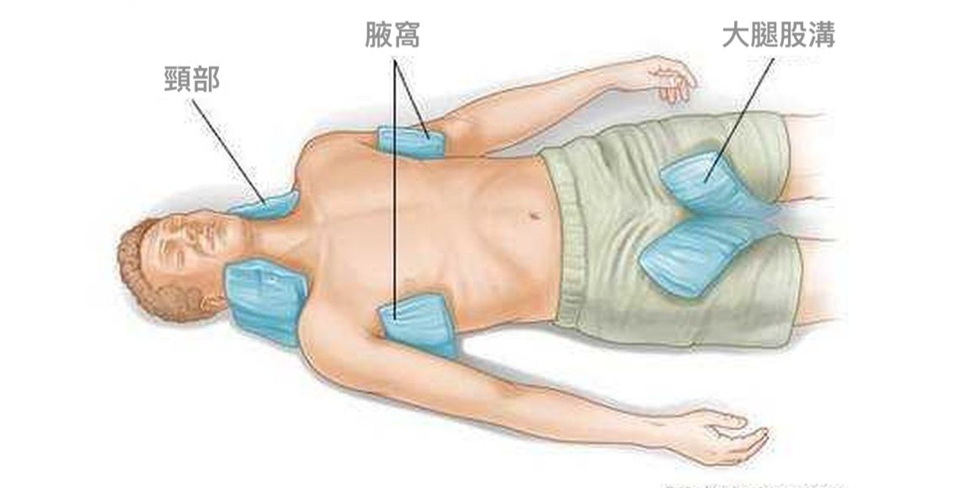 為中暑者急救，可用冰袋或冷水沾濕的毛巾，敷在頸部、腋窩或大腿股溝處等大動脈血管部位，幫助散熱。（圖片：chineseineurope）