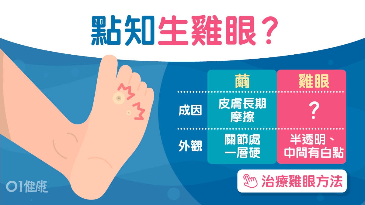 腳底痛|疣雞眼繭點分點預防?免搞錯愈剪愈痛兼傳染認住粒白點! 腳底痛|疣雞眼繭點分點預防?免搞錯愈剪愈痛兼傳染認住粒白點!