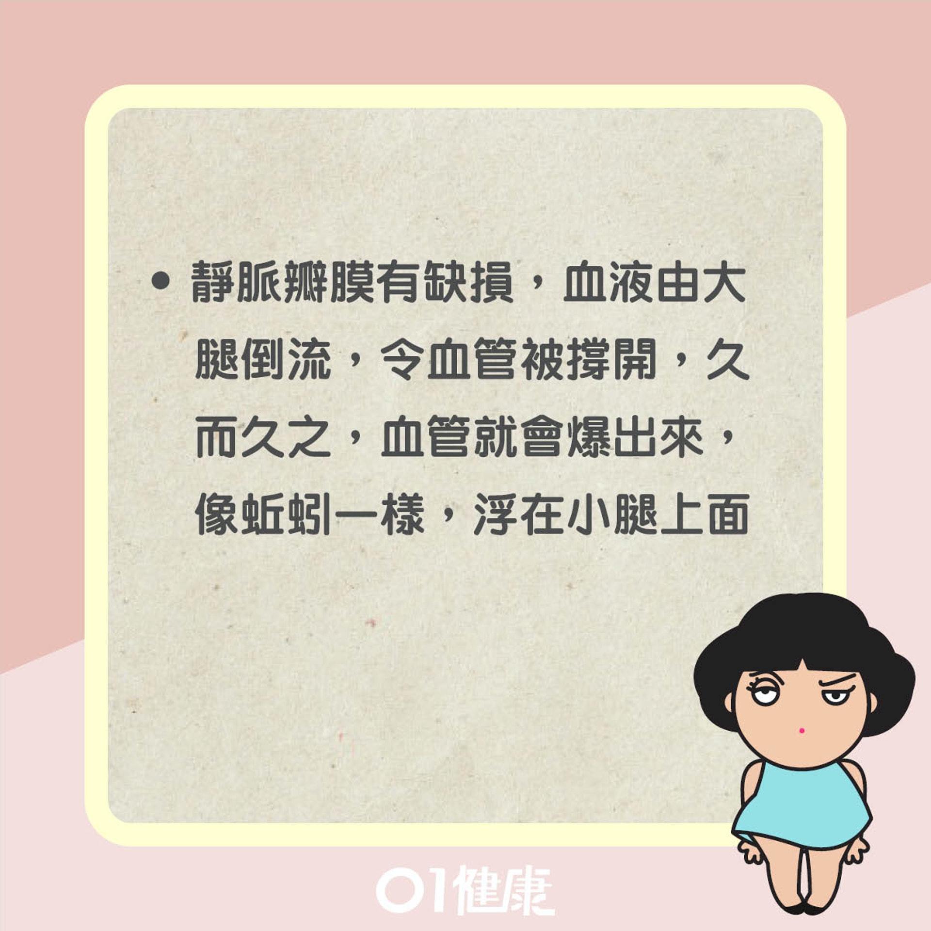 靜脈曲張知多啲(01製圖) 靜脈曲張知多啲(01製圖)