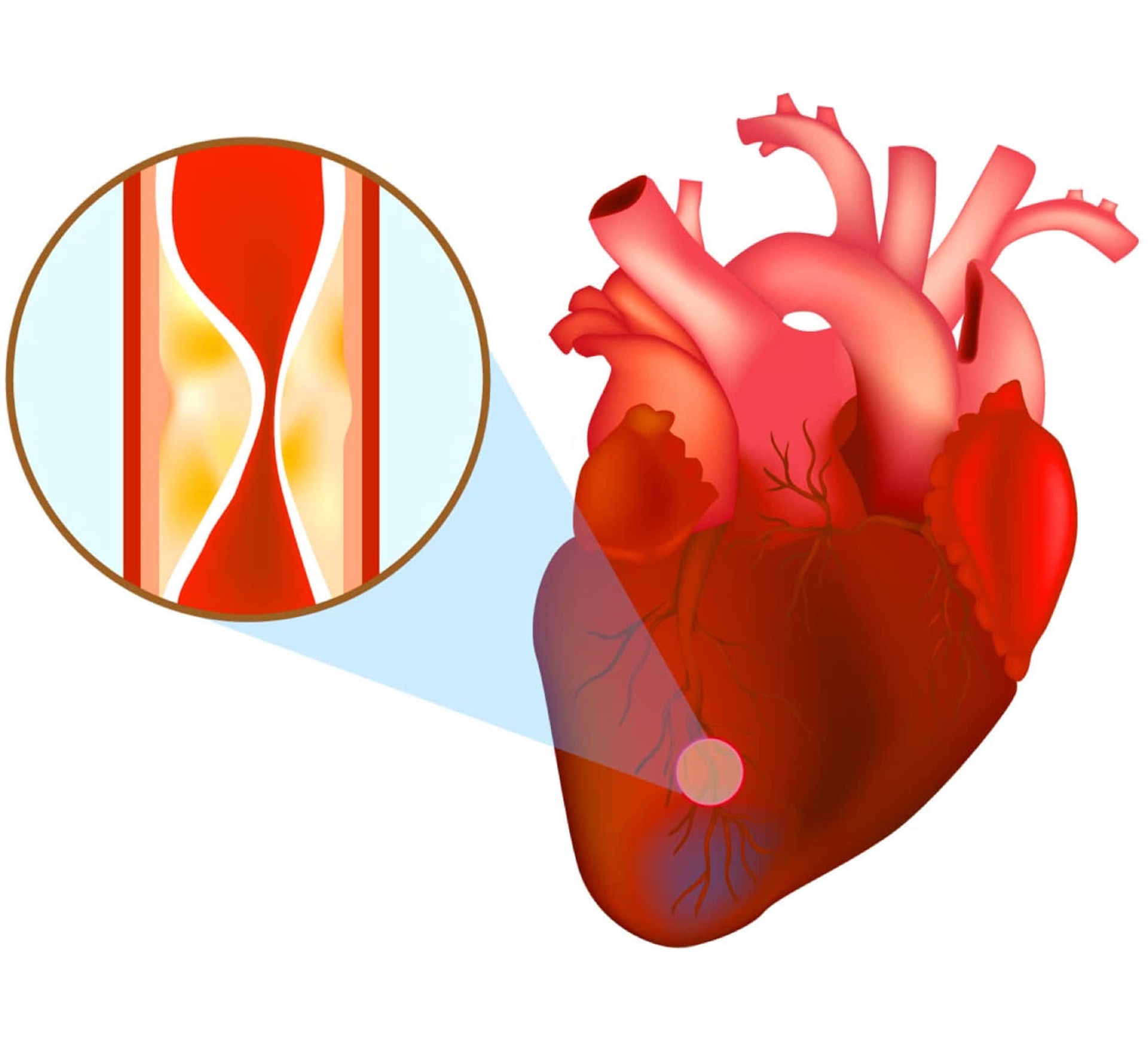 冠心病的成因是由於向心臟供應血流的冠狀動脈被阻塞，血流無法通過，令心肌缺氧繼而壞死，有機會導致患者猝死。（圖片：23mofang）