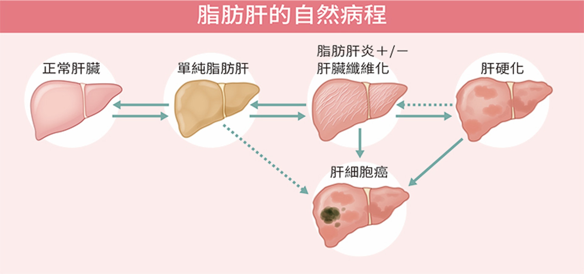 脂肪肝若不及早治療,或會演變成肝硬化,甚至肝癌。(圖片:全民健康基金會) 脂肪肝若不及早治療,或會演變成肝硬化,甚至肝癌。(圖片:全民健康基金會)