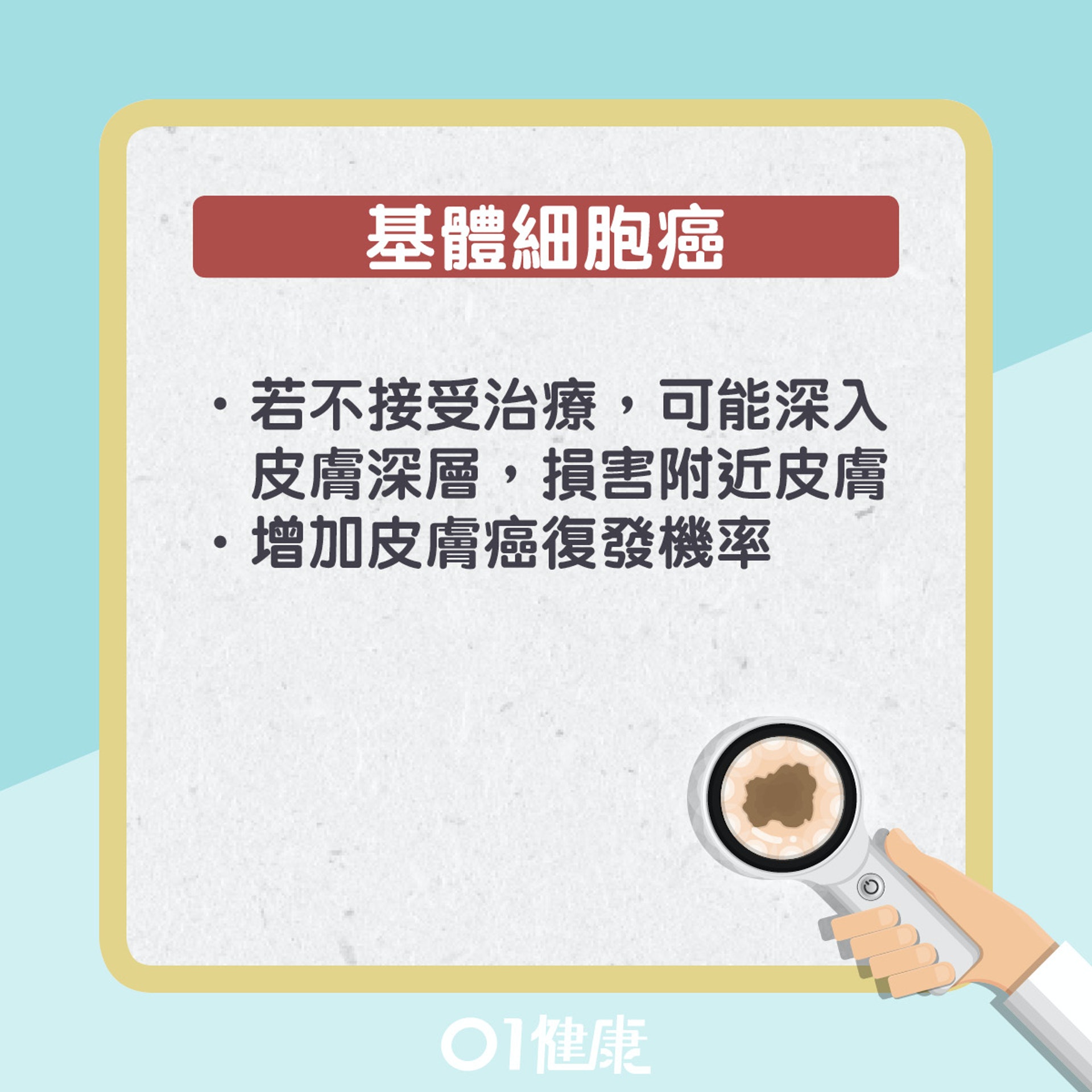 基體細胞癌其實是甚麼?(01製圖) 基體細胞癌其實是甚麼?(01製圖)
