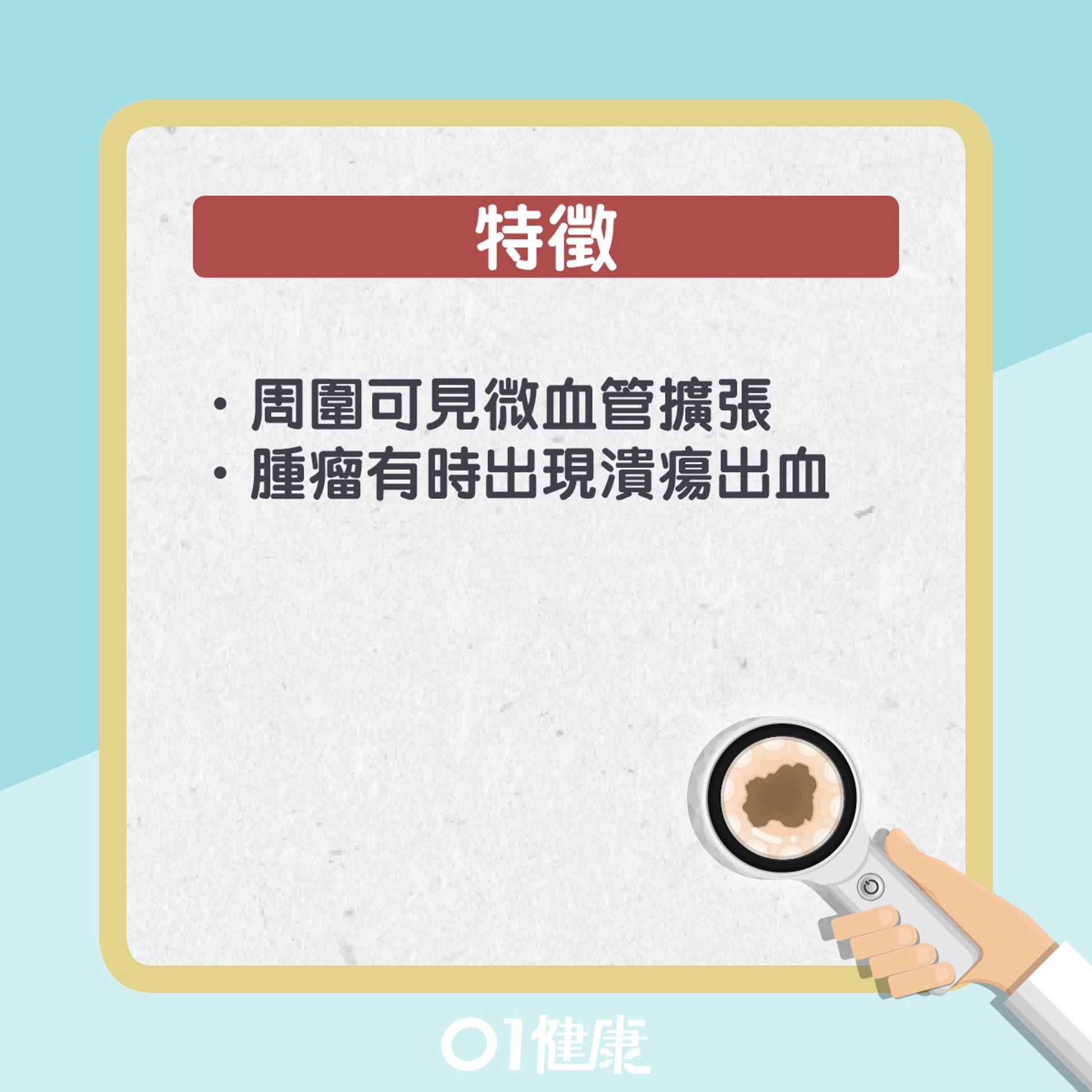 基體細胞癌其實是甚麼?(01製圖) 基體細胞癌其實是甚麼?(01製圖)