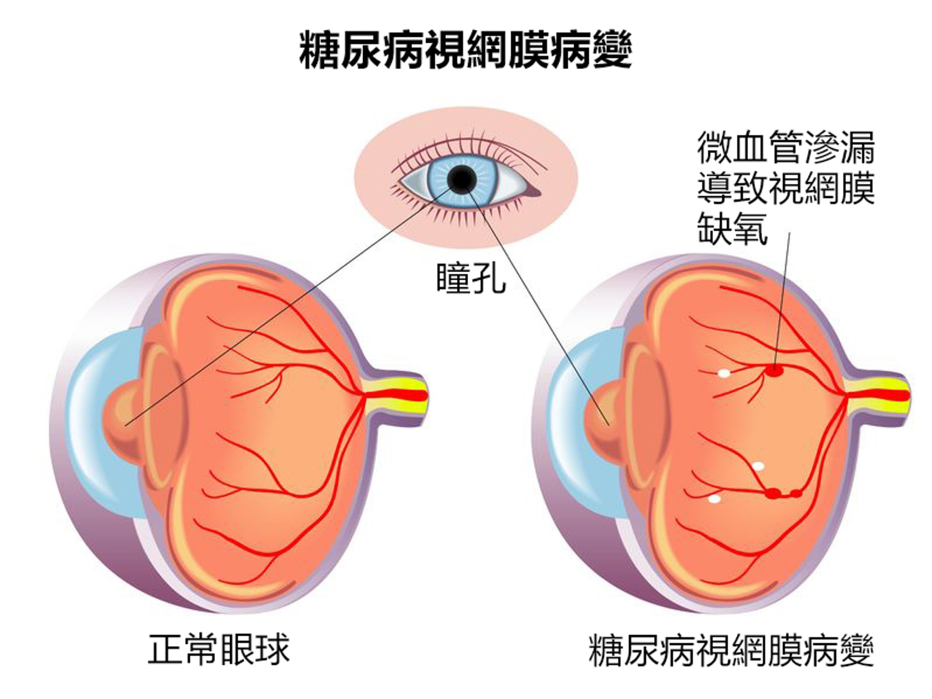 「糖尿上眼」輕則影響視力，重則可以致盲。（圖片：香港激光矯視中心）