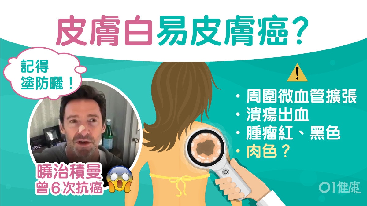 皮膚癌｜曉治積曼疑癌復發籲大家切記塗防曬！5類人易中招勿曬燈?