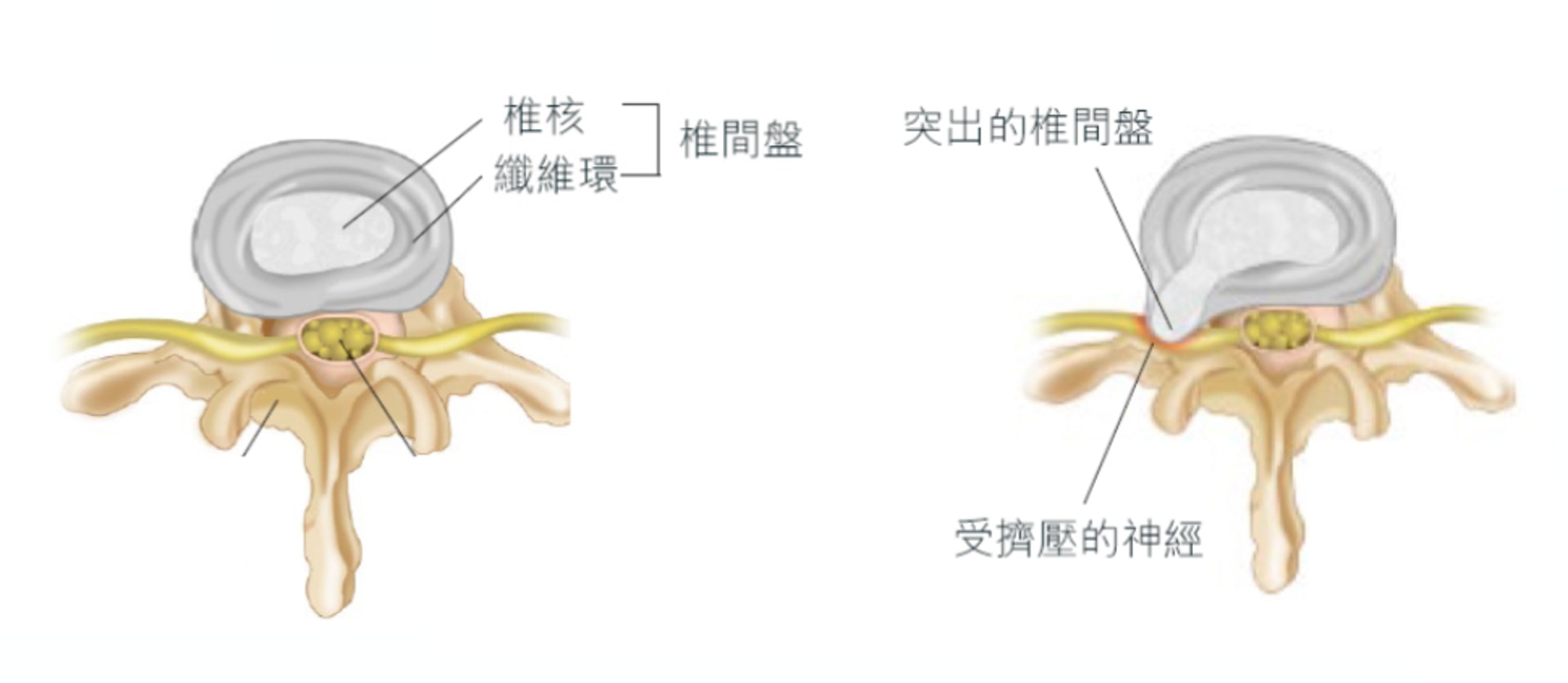 椎間盤結構圖（左）及椎間盤突出（右）。（圖片：asiamedicalspecialists）
