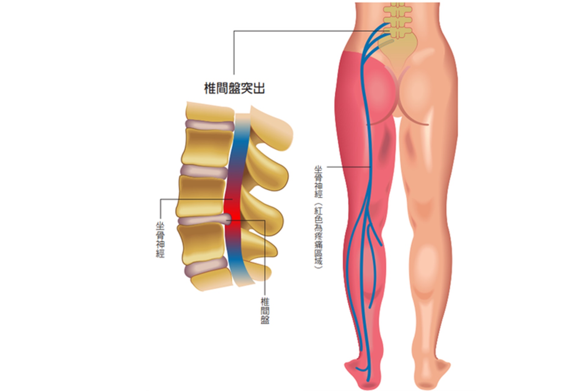 椎間盤突出會導致坐骨神經痛，而由於突出的方向通常偏向其中一側，所以疼痛通常都出現在單側。（圖片：health.udn）