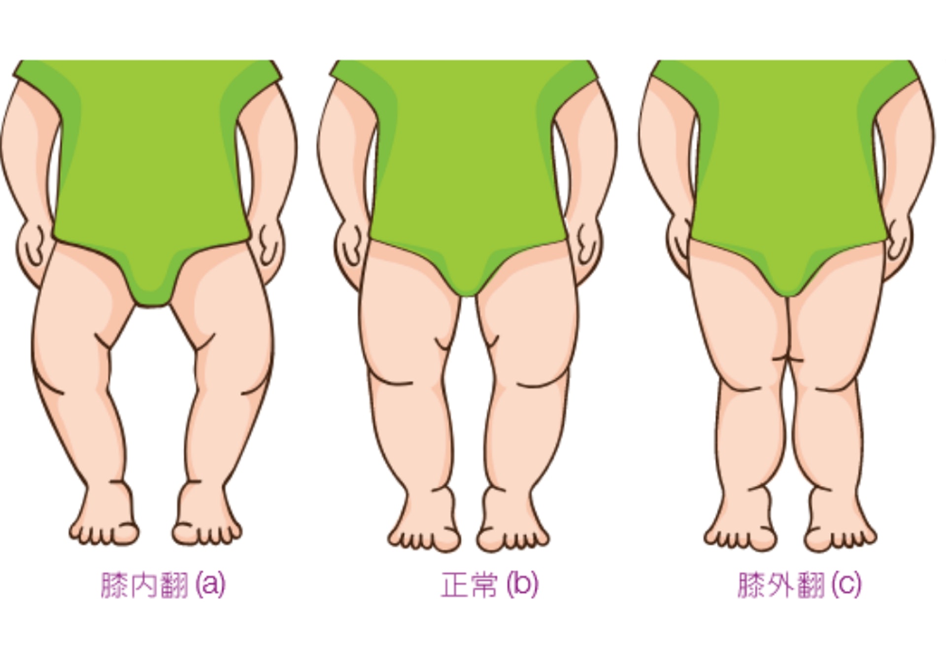 O形腳是指膝部不正常地向內翻，而X形腳則剛剛相反，是指膝部不正常地向外翻 (圖片：醫院管理局)