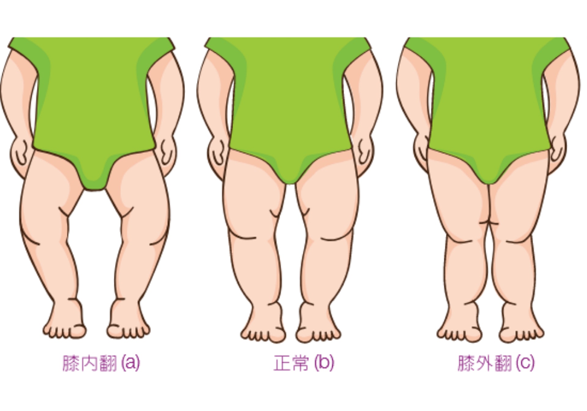 O形腳是指膝部不正常地向內翻,而X形腳則剛剛相反,是指膝部不正常地向外翻 (圖片:醫院管理局) O形腳是指膝部不正常地向內翻,而X形腳則剛剛相反,是指膝部不正常地向外翻 (圖片:醫院管理局)