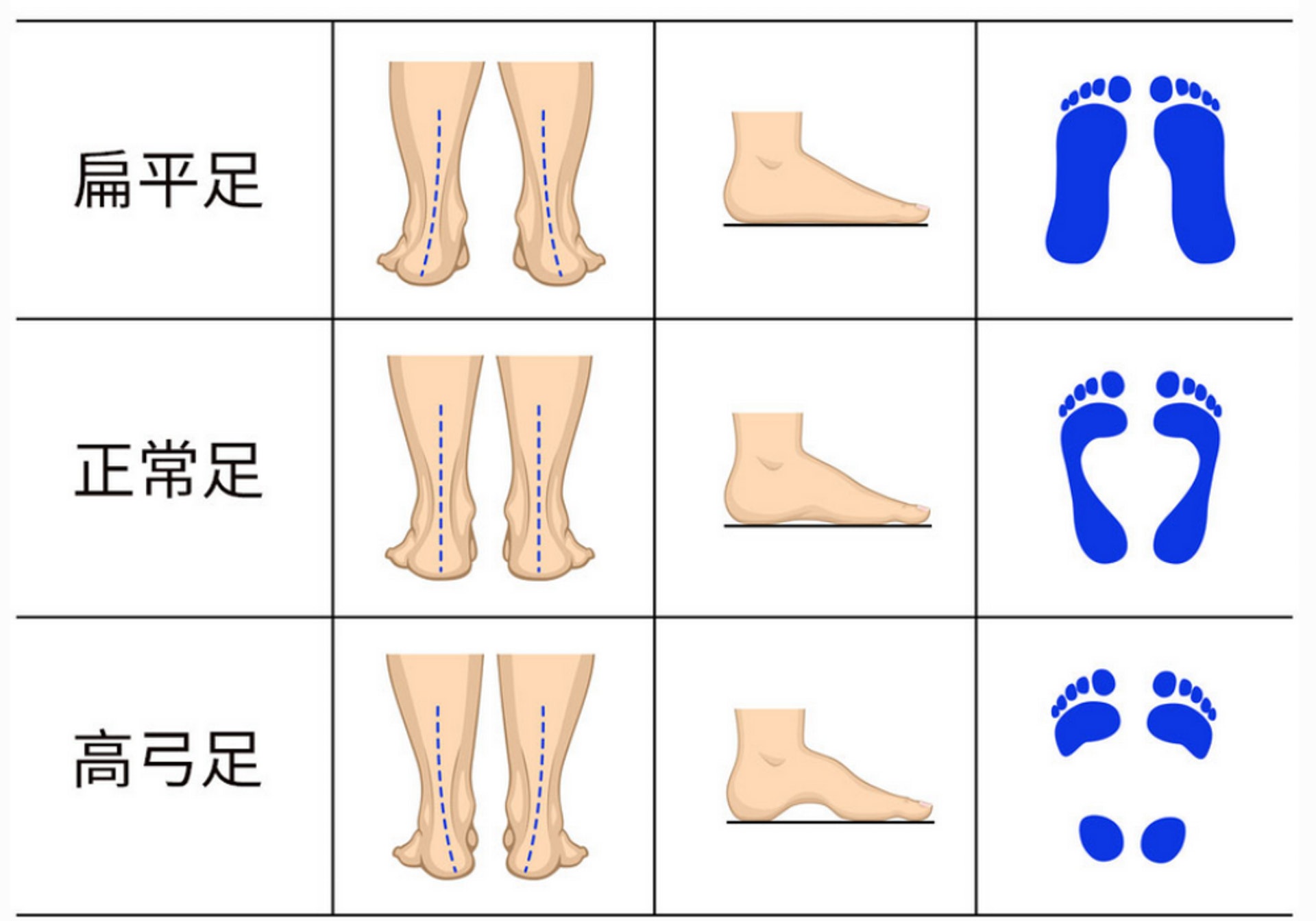 三種腳形 (圖片：台灣營養)