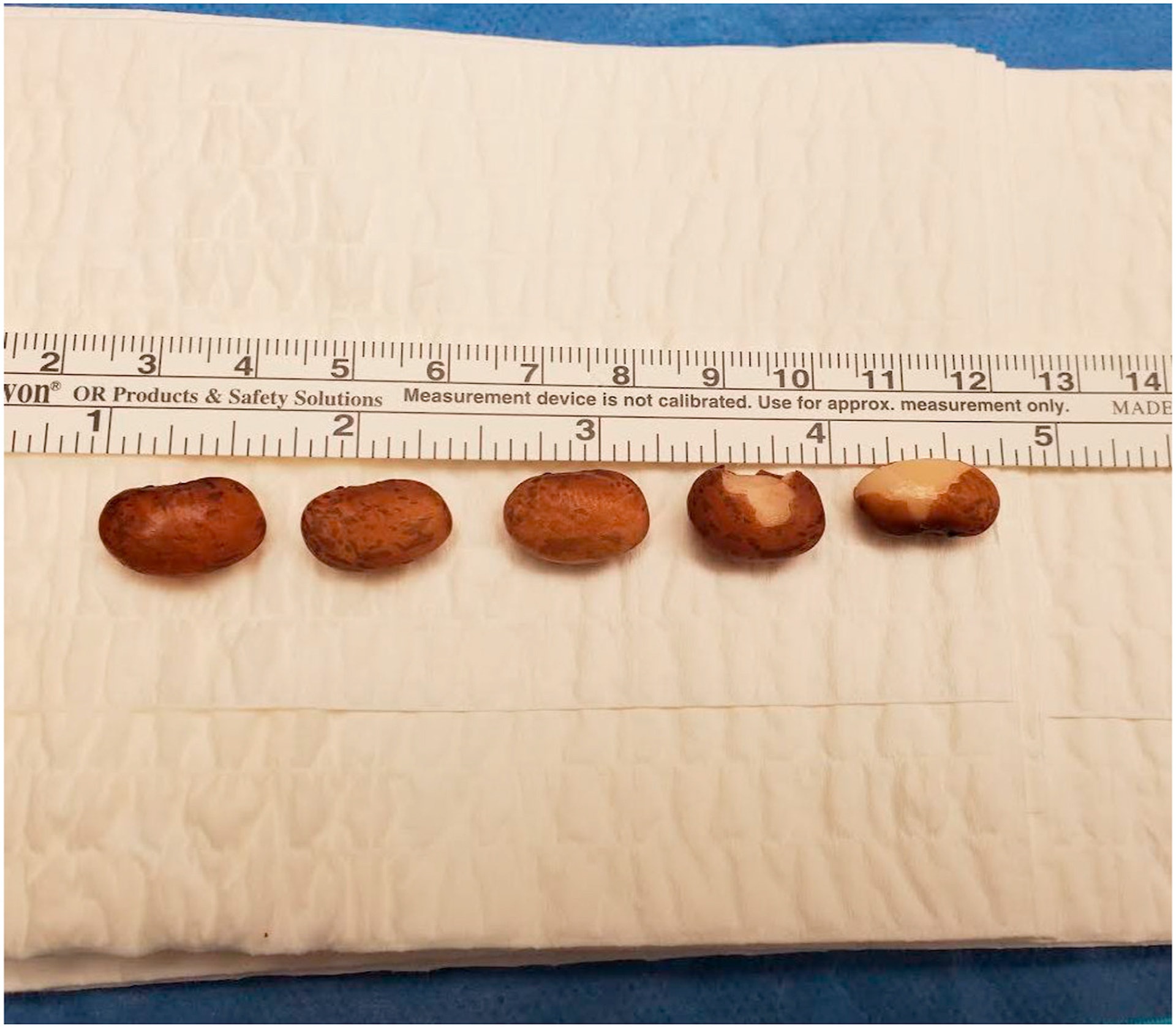 醫生以人手擠壓的方式擠出1顆腰豆,後來再做手術取出其餘5顆。(Urology Case Reports圖片) 醫生以人手擠壓的方式擠出1顆腰豆,後來再做手術取出其餘5顆。(Urology Case Reports圖片)