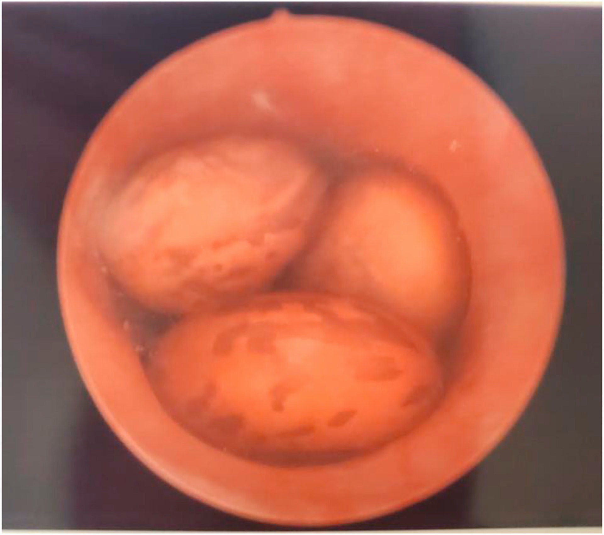 其中有4顆腰豆更貼在一起,醫生需仔細地逐顆取出。(Urology Case Reports圖片) 其中有4顆腰豆更貼在一起,醫生需仔細地逐顆取出。(Urology Case Reports圖片)