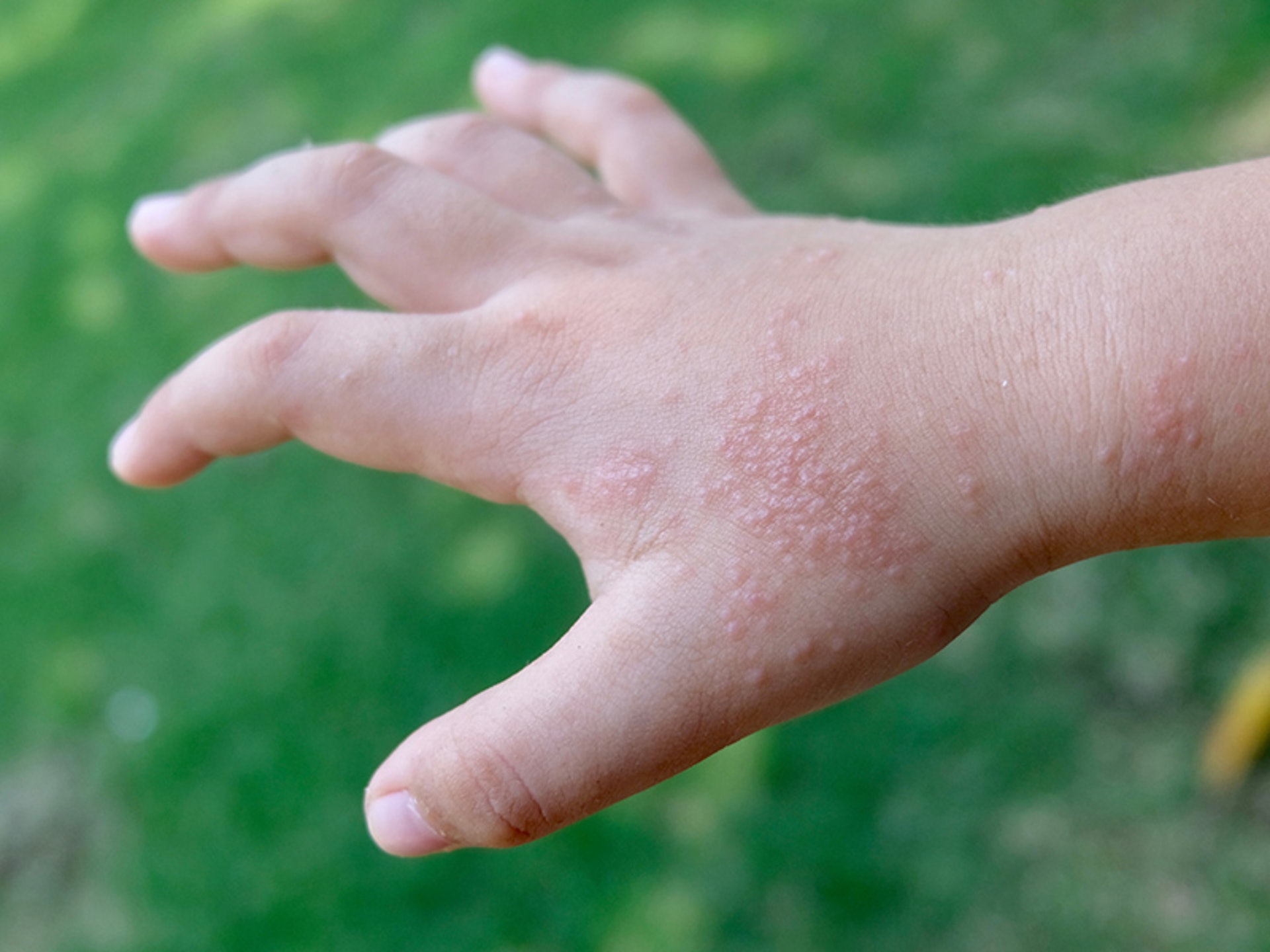 汗皰疹患者一般會在手指、腳趾、手掌或腳掌兩側，產生或多或少的小水泡。（圖片：mombaby）