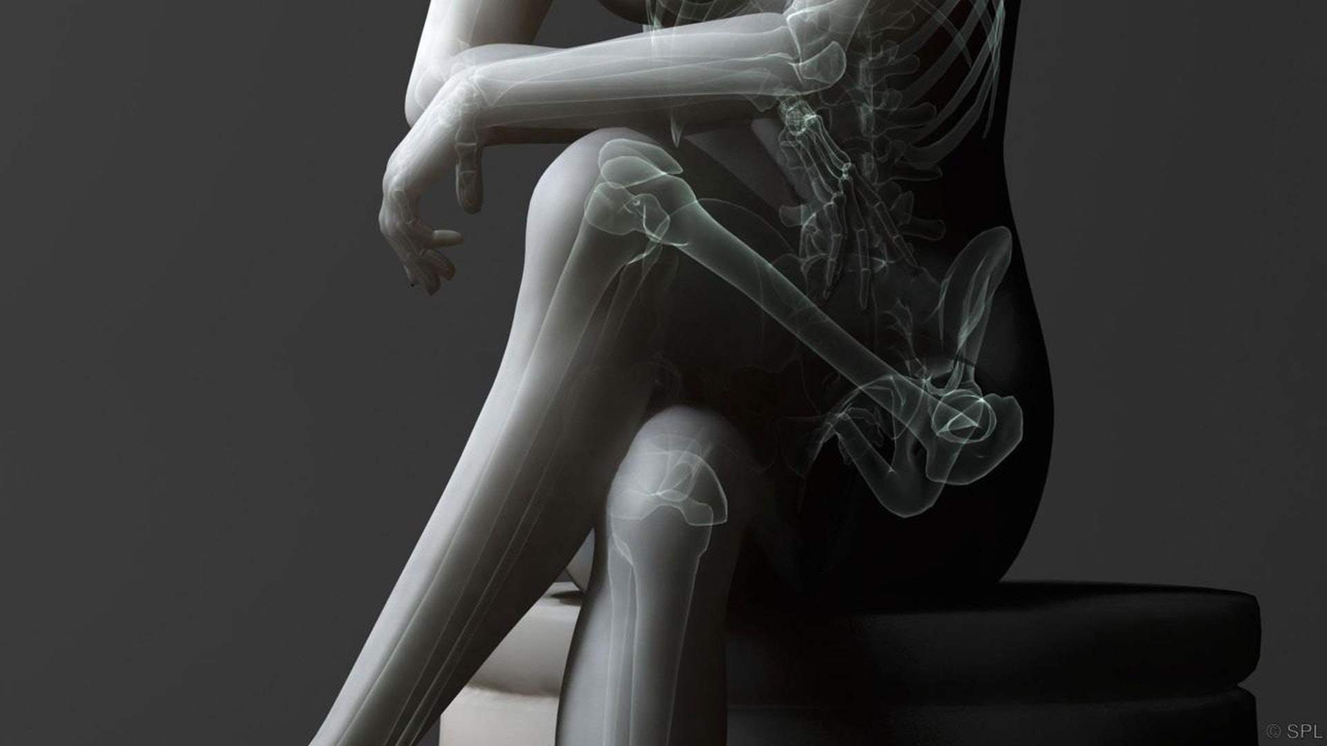 翹腳時脊椎會傾側，短期會引致腰酸背痛、肩頸痠痛，長期下來更會導致高低肩，甚至骨盆歪斜及脊椎側彎。（圖片：medicalinspire）
