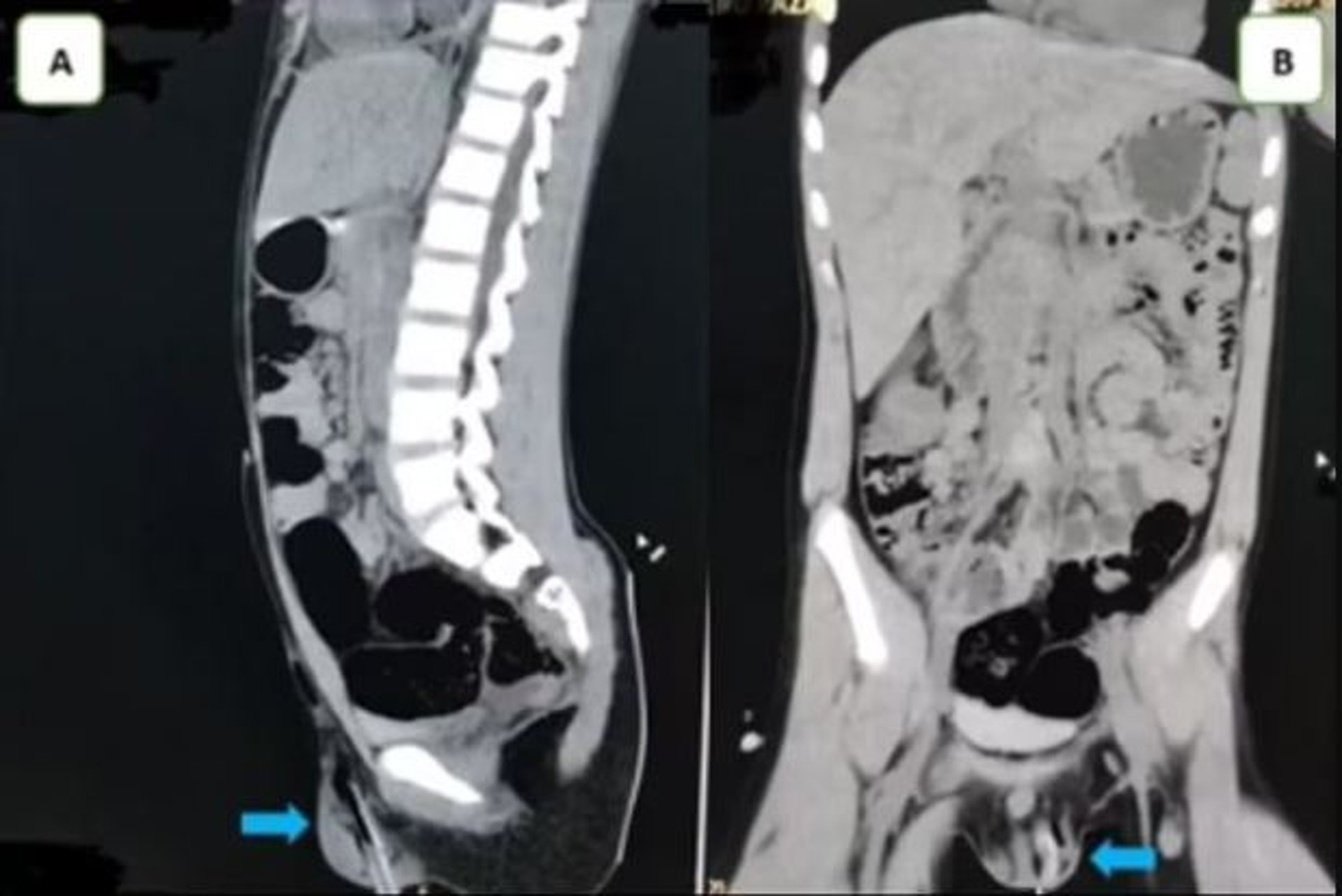 11歲男孩左側陰囊被樹枝刺穿。 （Urology Case Reports）