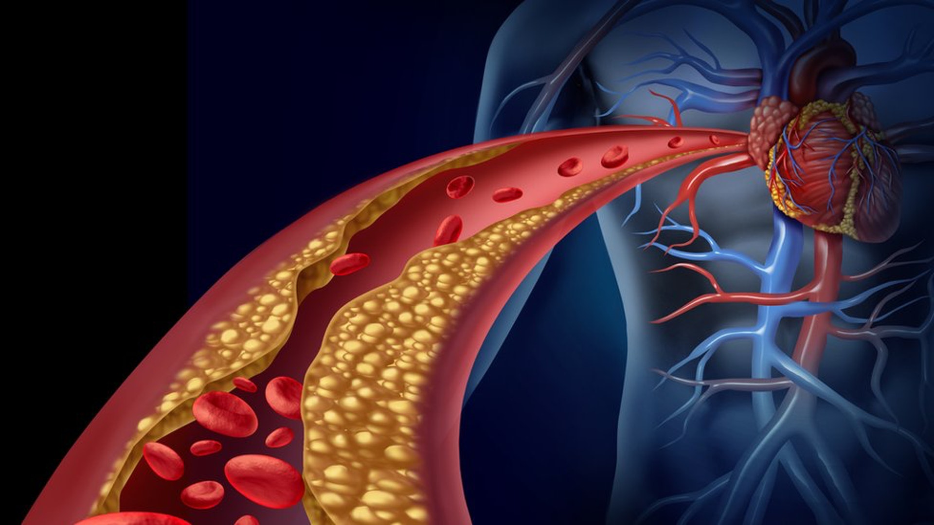 心臟病和膽固醇的高低是無直接關係，只是高膽固醇血症多數會引起心肌梗塞或是腦中風的情況。 （圖片：bbc）