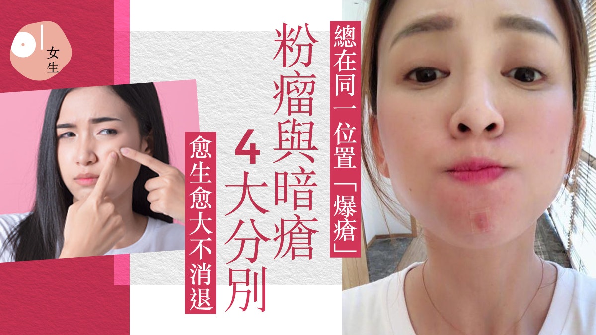 暗瘡|這位置爆瘡不是暗瘡不能擠?醫生解構對付暗瘡防 「爛面」 暗瘡|這位置爆瘡不是暗瘡不能擠?醫生解構對付暗瘡防 「爛面」