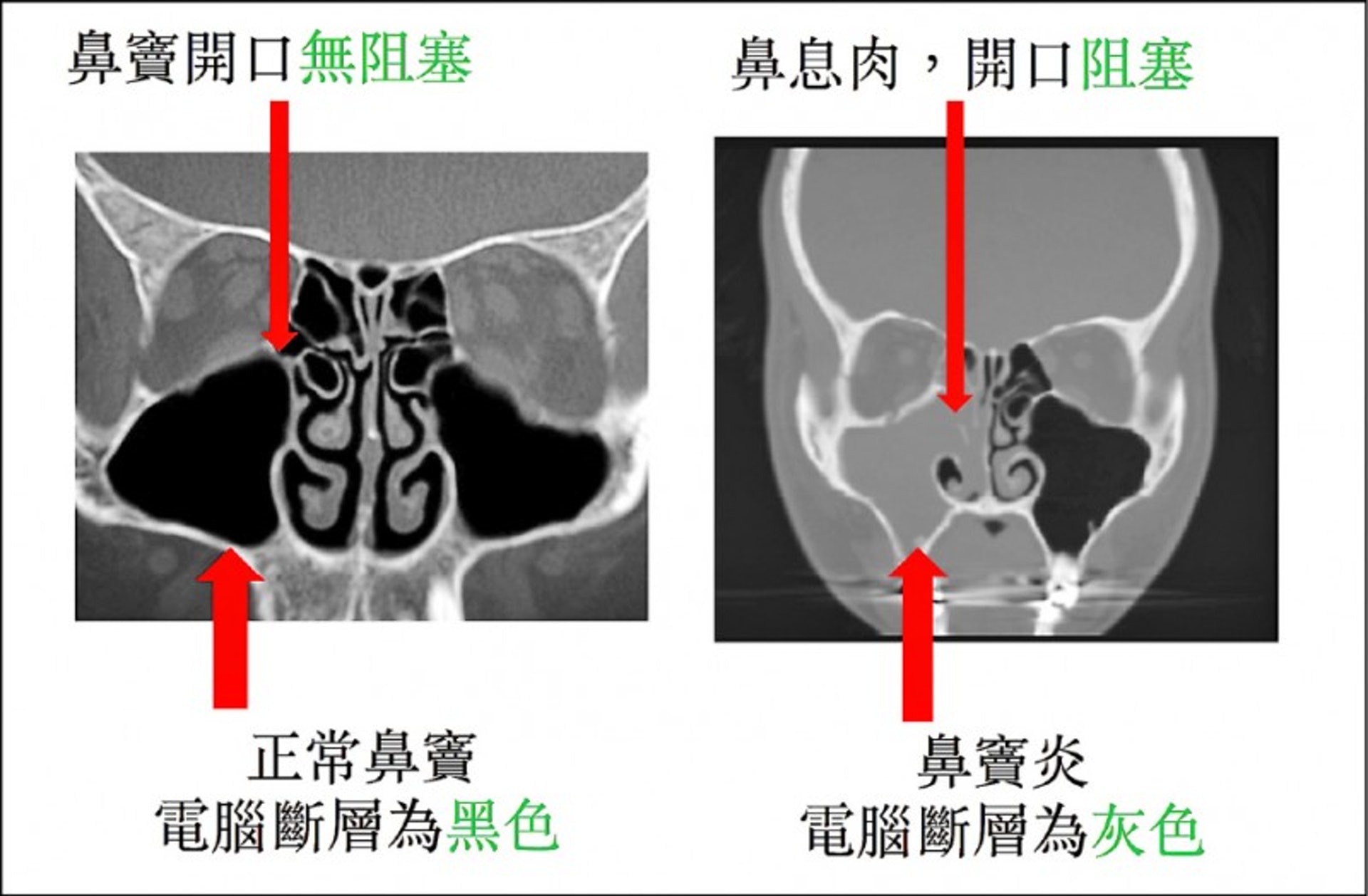 鼻竇炎的X光片，可見中間開口已阻塞。（圖片：自由時報）